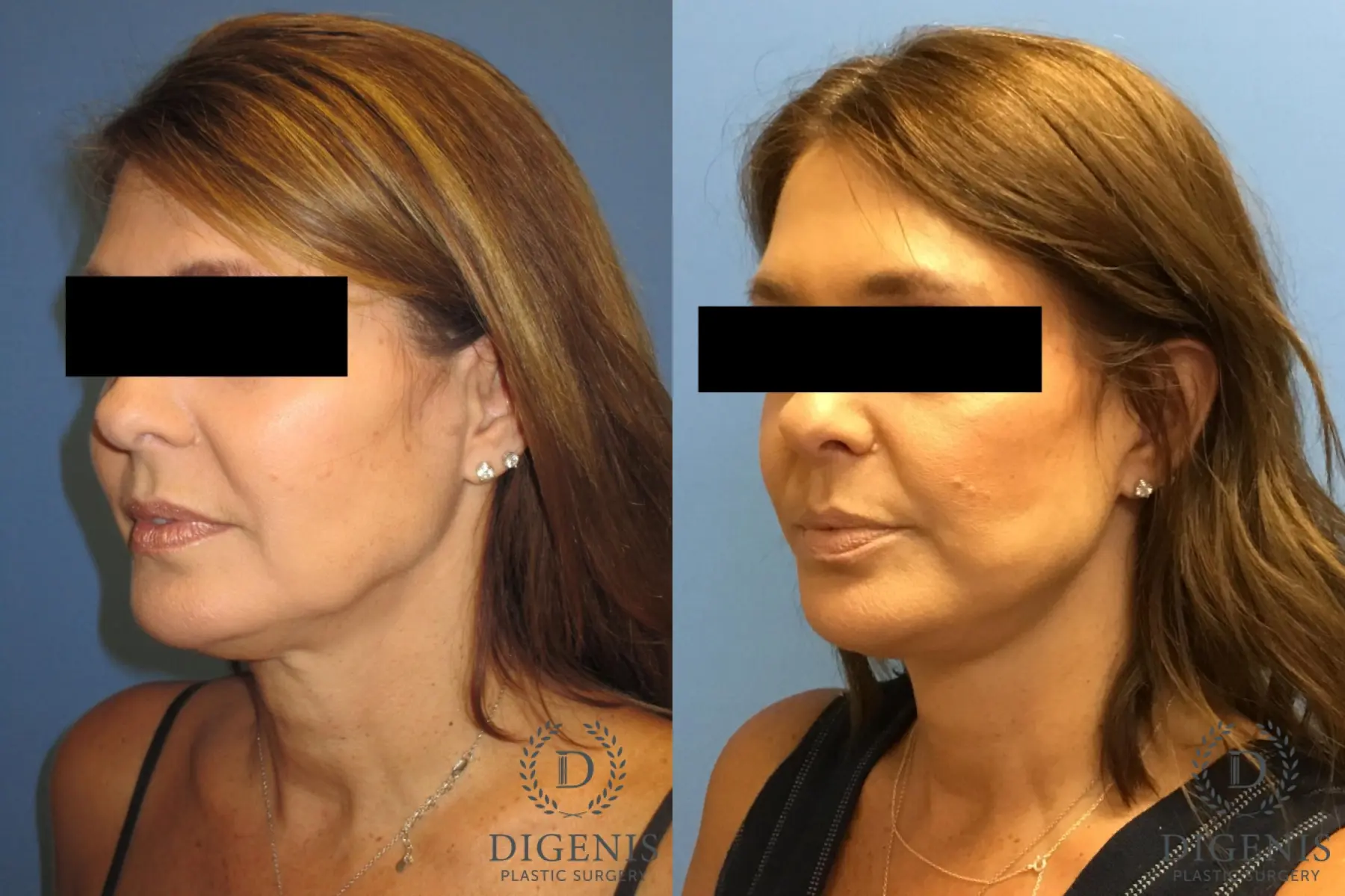 Facelift: Patient 10 - Before and After 4
