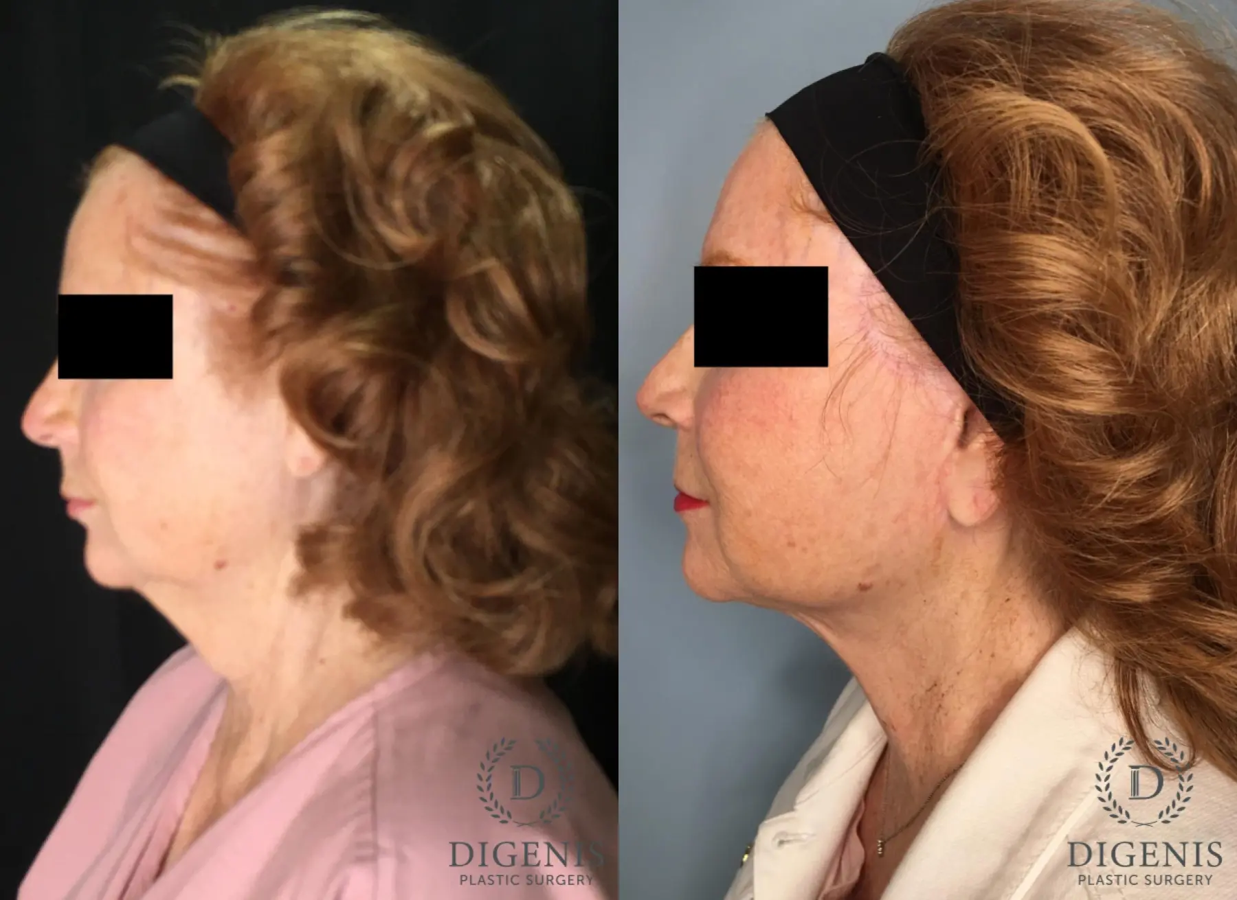Facelift: Patient 2 - Before and After 5