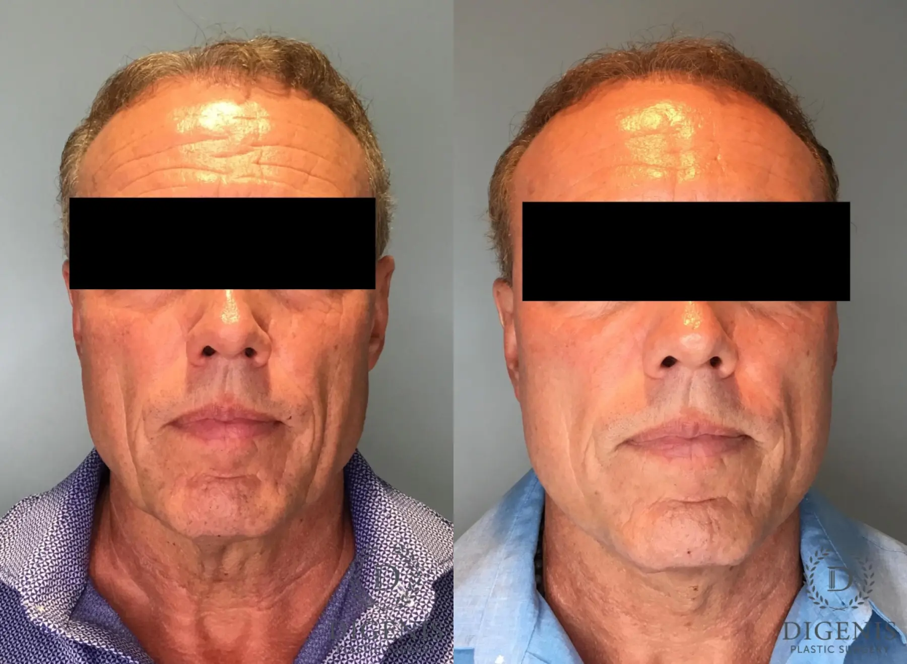 Facelift: Patient 62 - Before and After 1