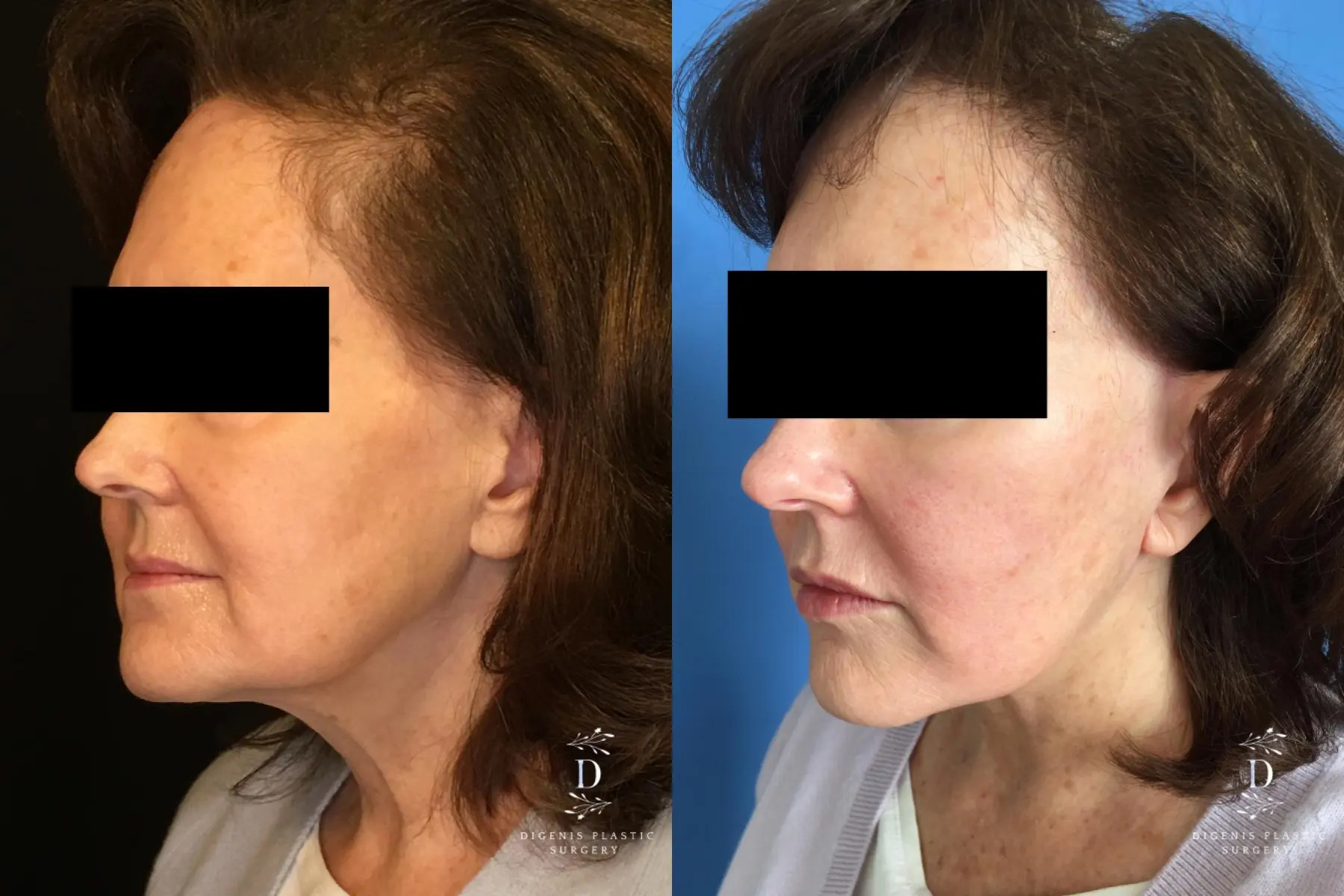 Facelift: Patient 17 - Before and After 3