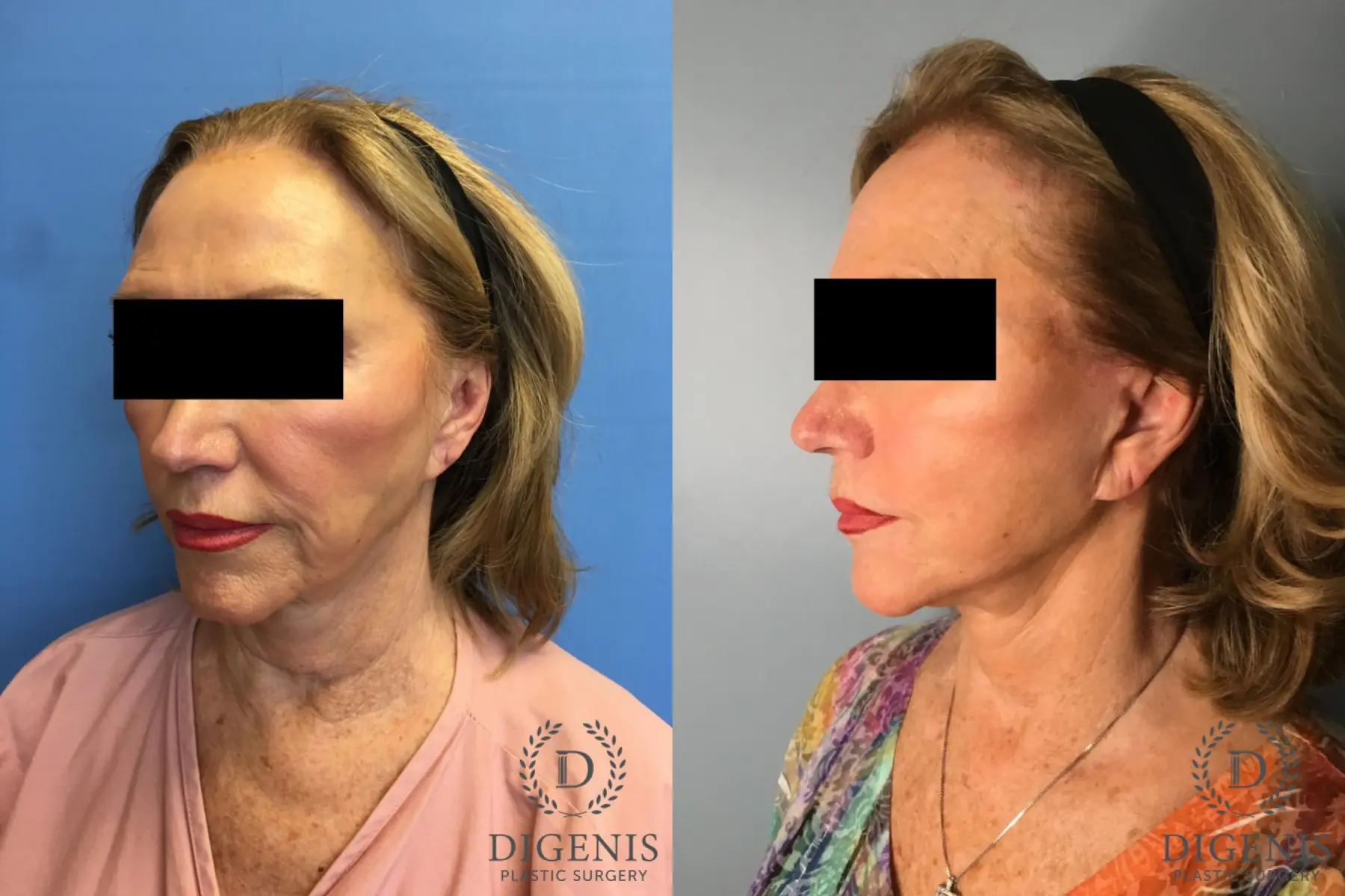 Facelift: Patient 25 - Before and After 4