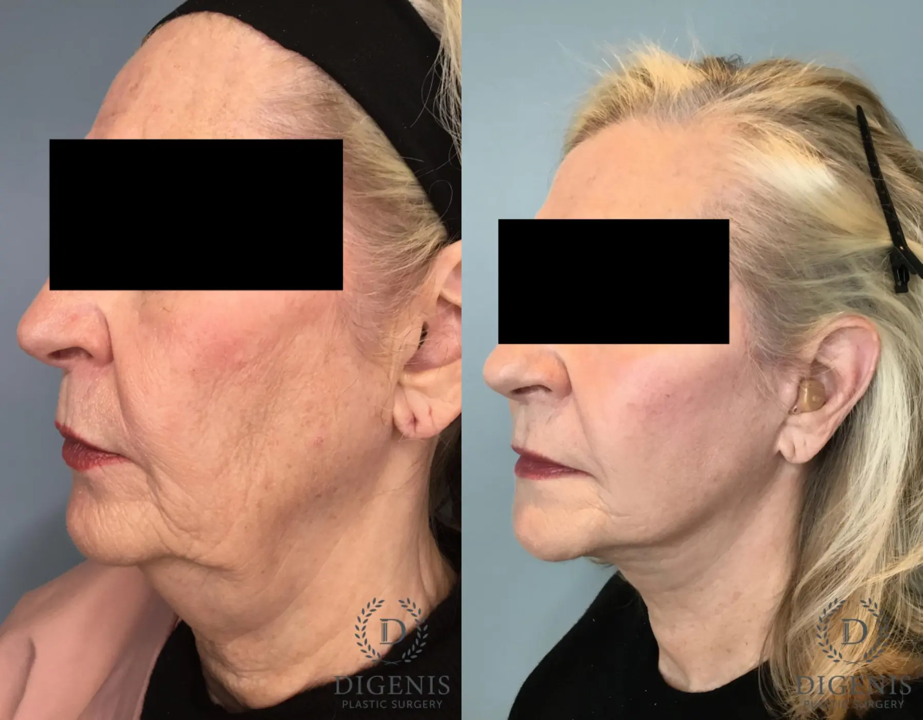 Facelift: Patient 67 - Before and After 2