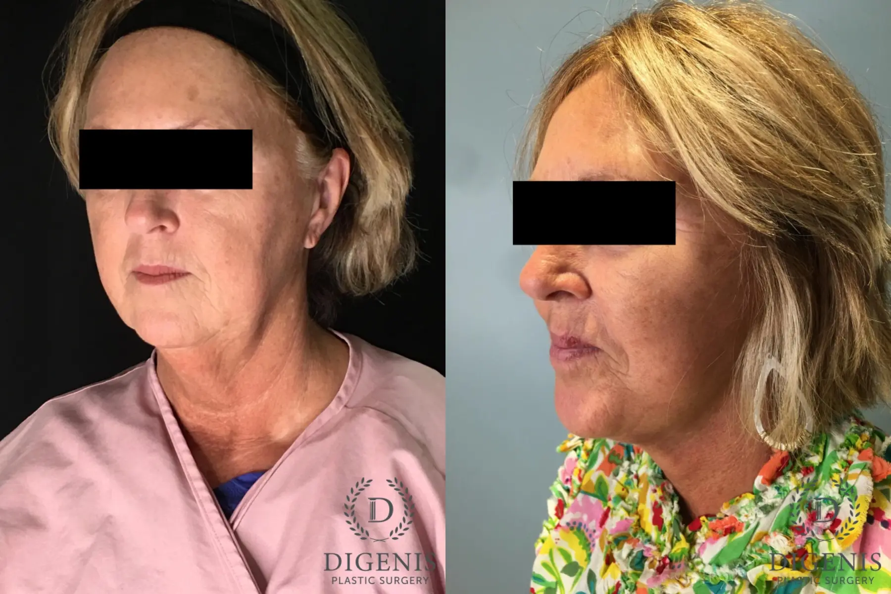 Facelift: Patient 27 - Before and After 4