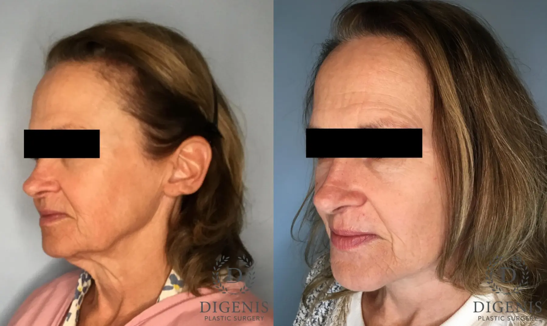 Facelift: Patient 16 - Before and After 4