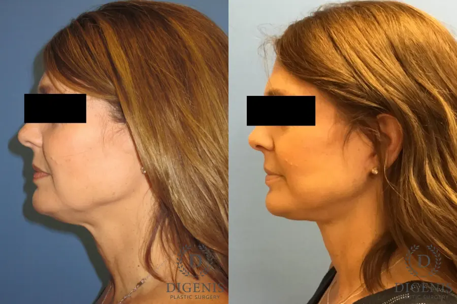 Facelift: Patient 10 - Before and After 5