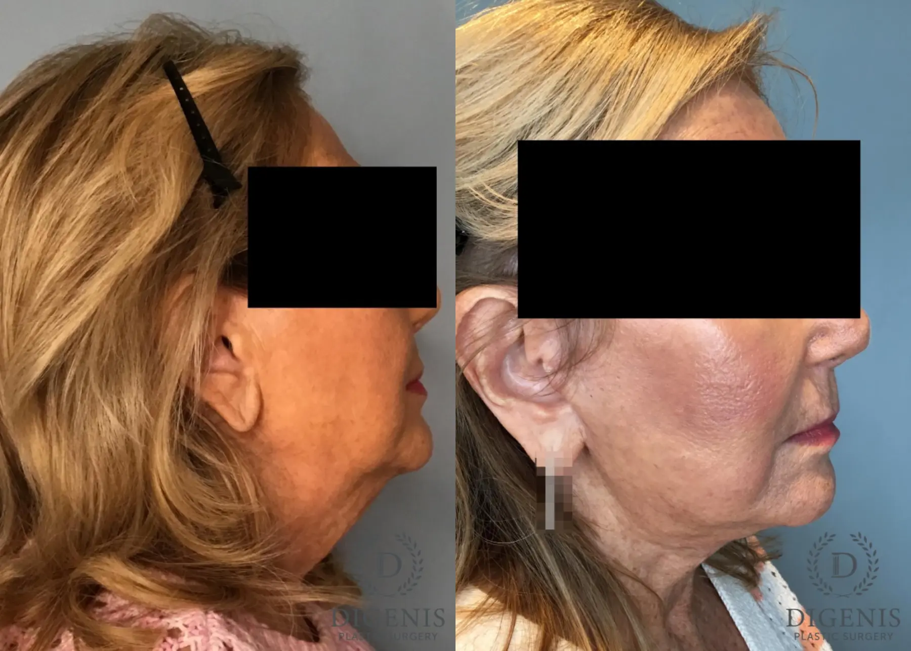 Facelift: Patient 69 - Before and After 3