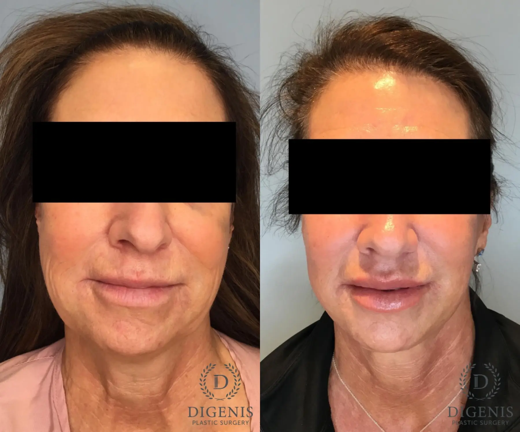 Facelift: Patient 62 - Before and After  