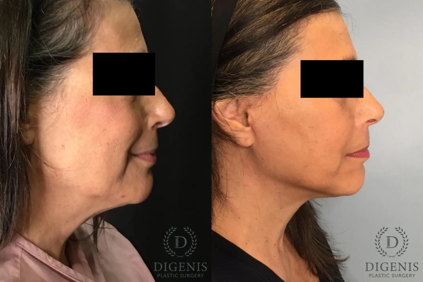 Facelift: Patient 26 - Before and After 3