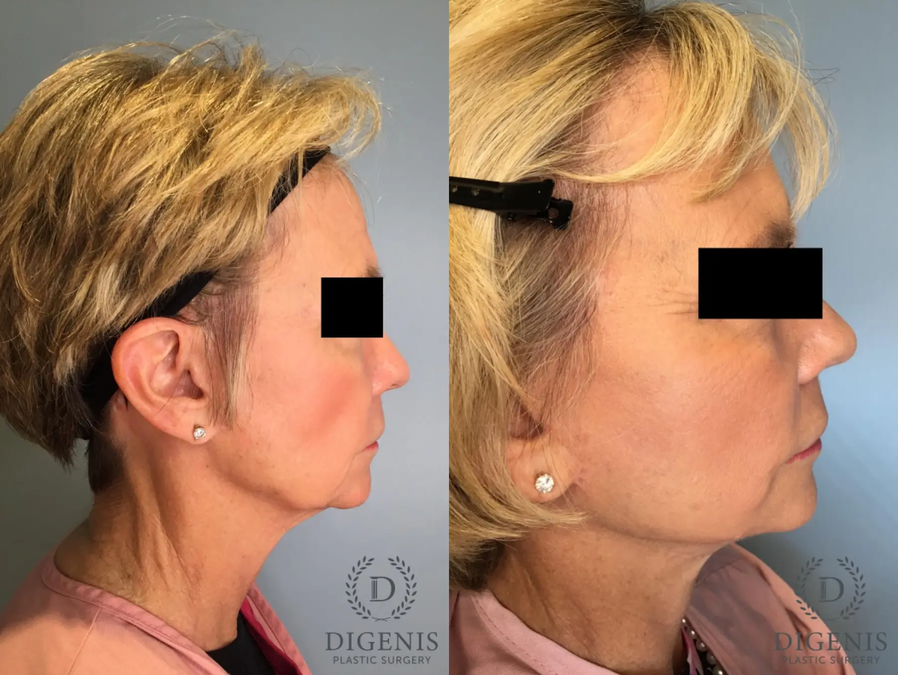 Facelift: Patient 14 - Before and After 5