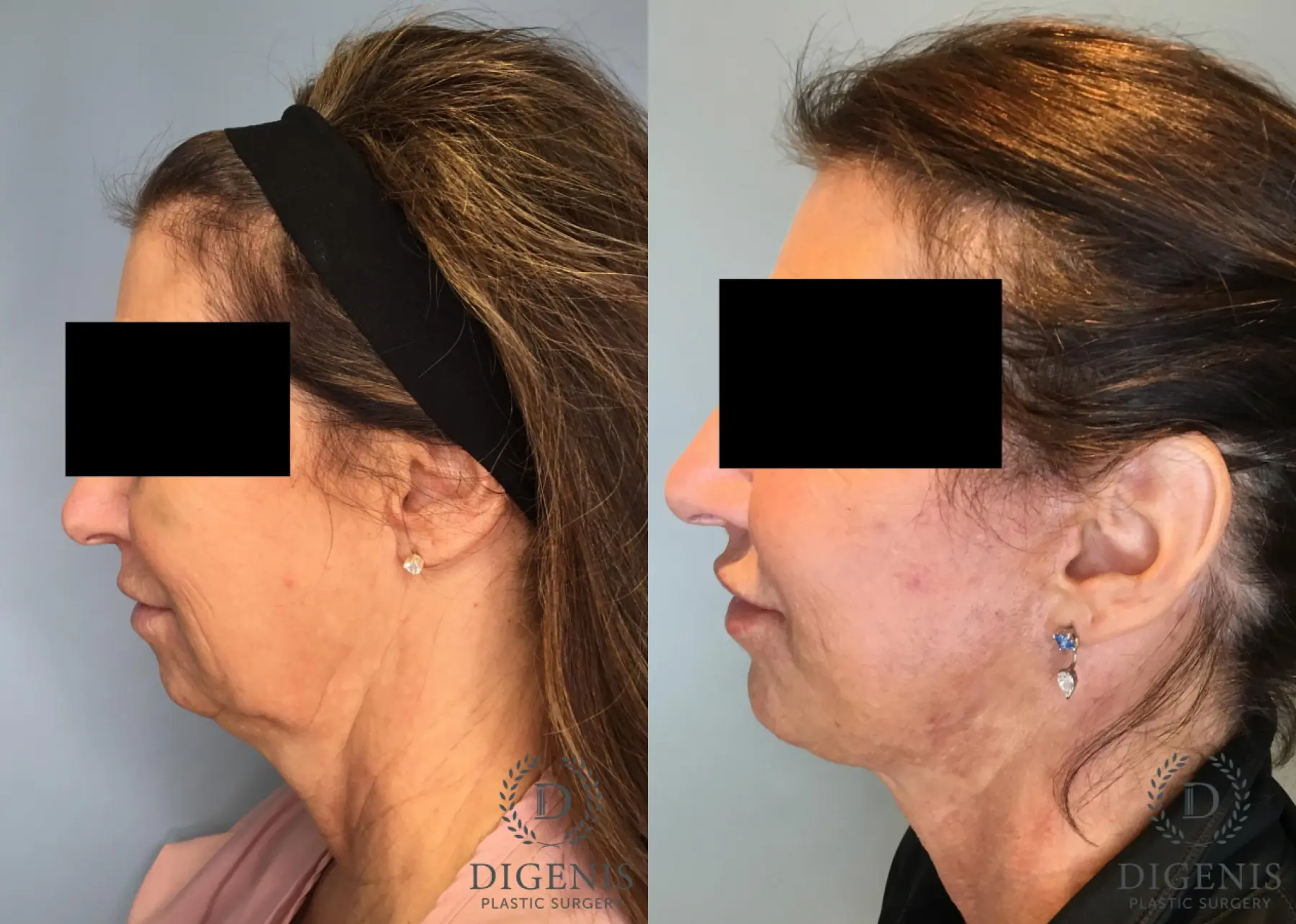 Facelift: Patient 62 - Before and After 5