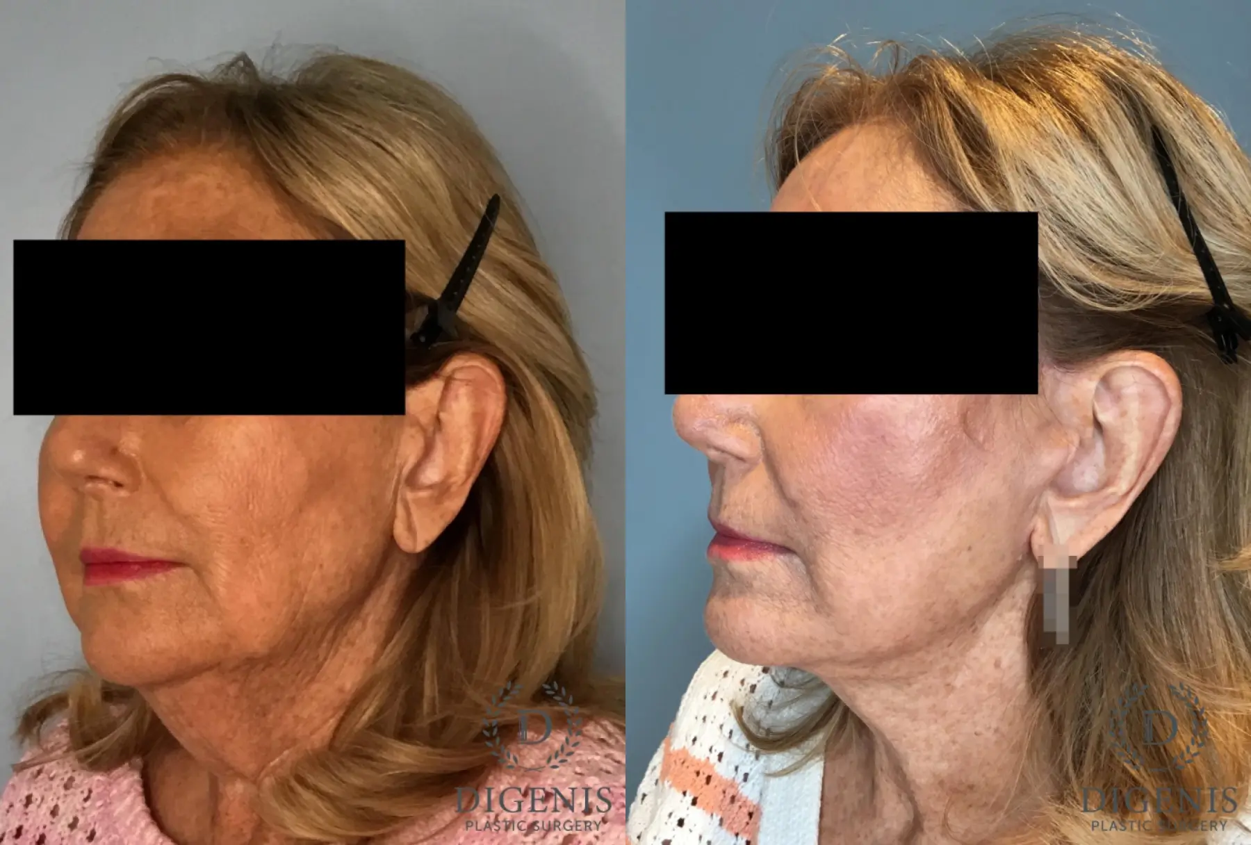 Facelift: Patient 69 - Before and After 4