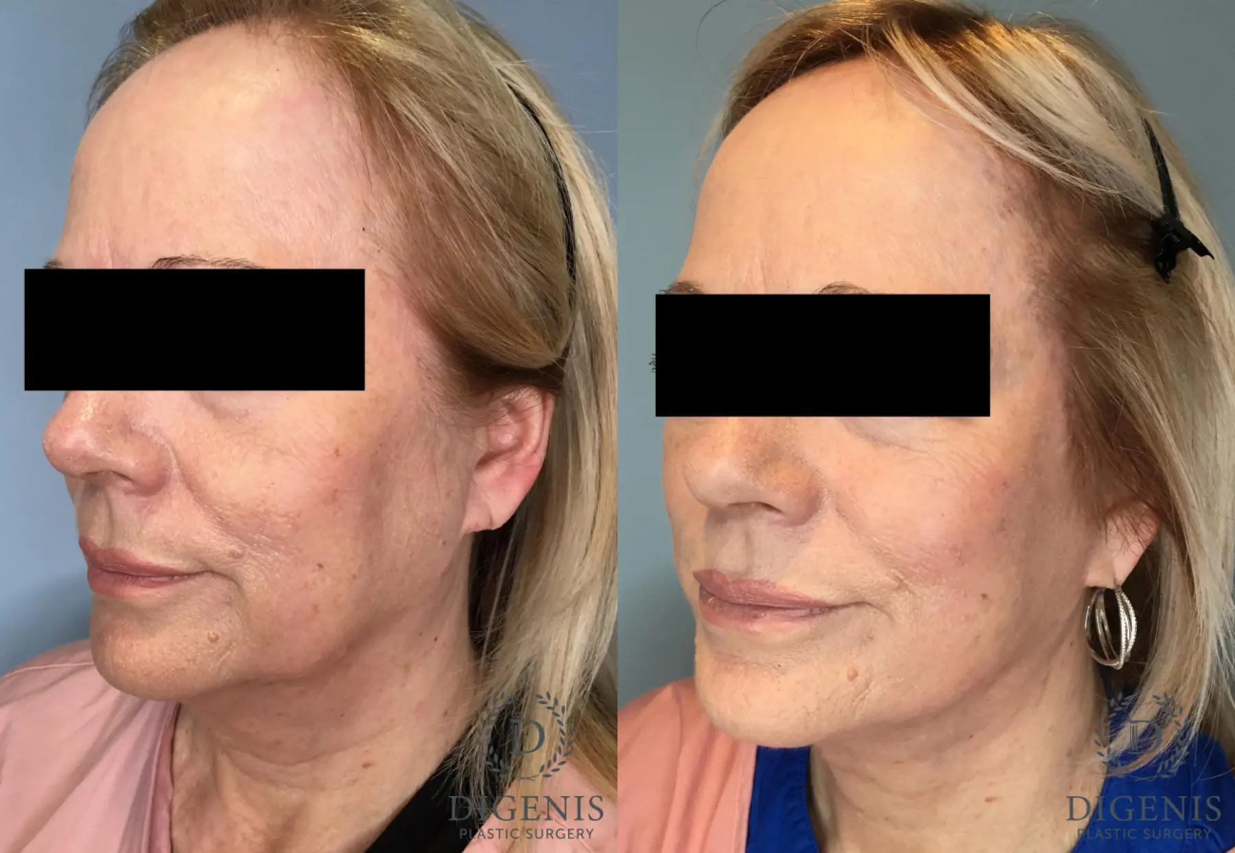 Facelift: Patient 66 - Before and After 2