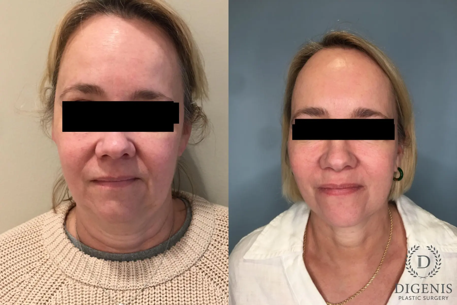 Facelift: Patient 30 - Before and After  