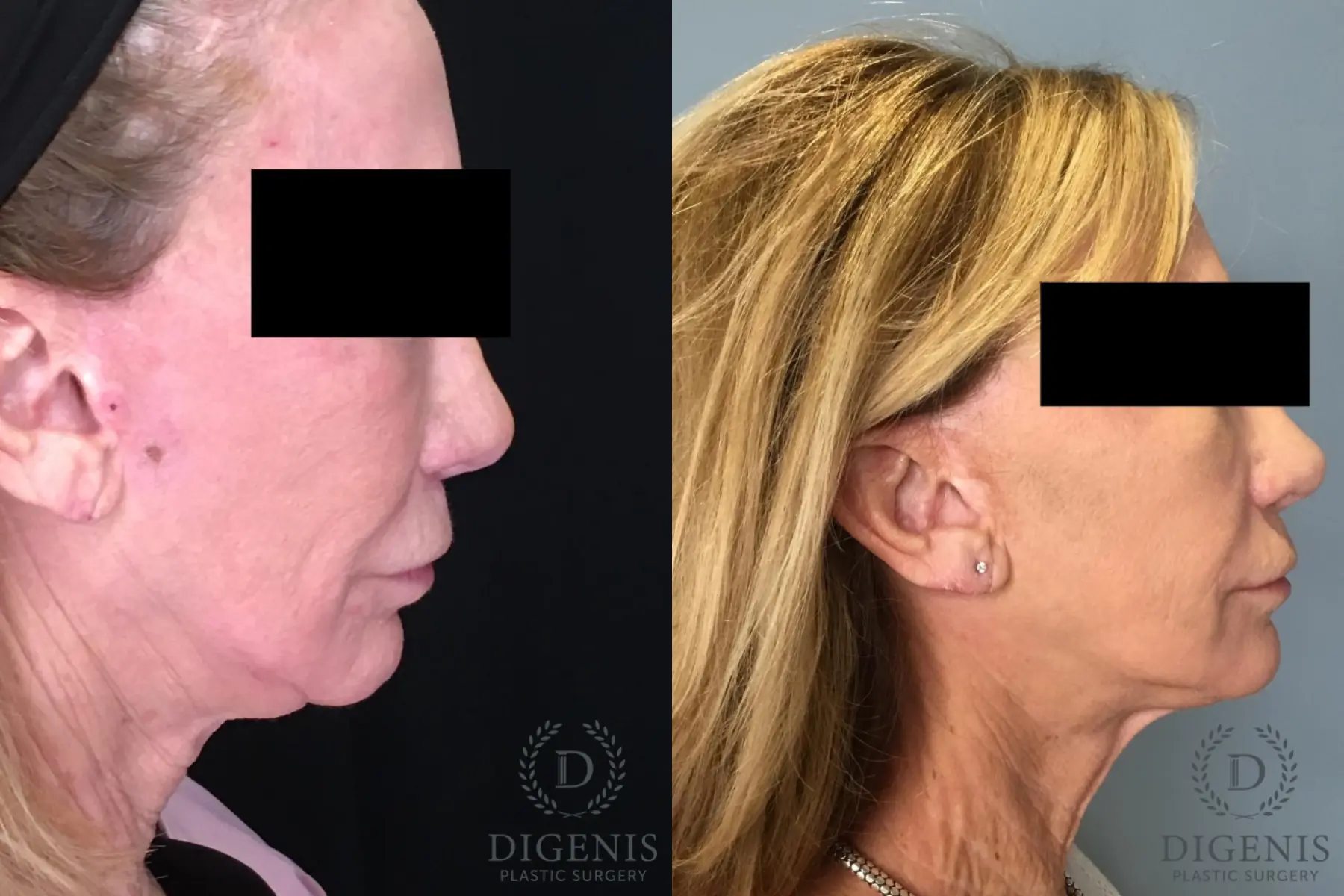 Facelift: Patient 64 - Before and After 5
