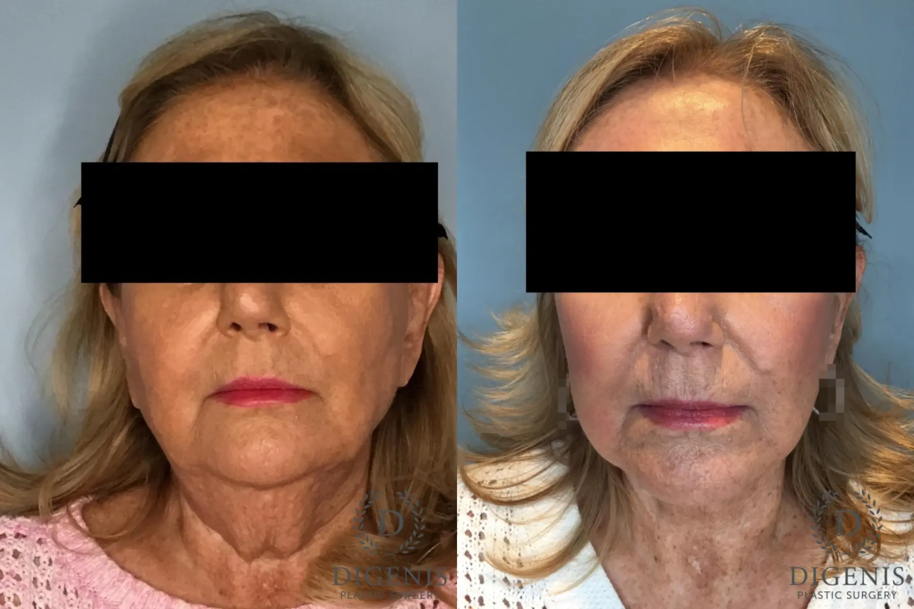 Facelift: Patient 69 - Before and After  