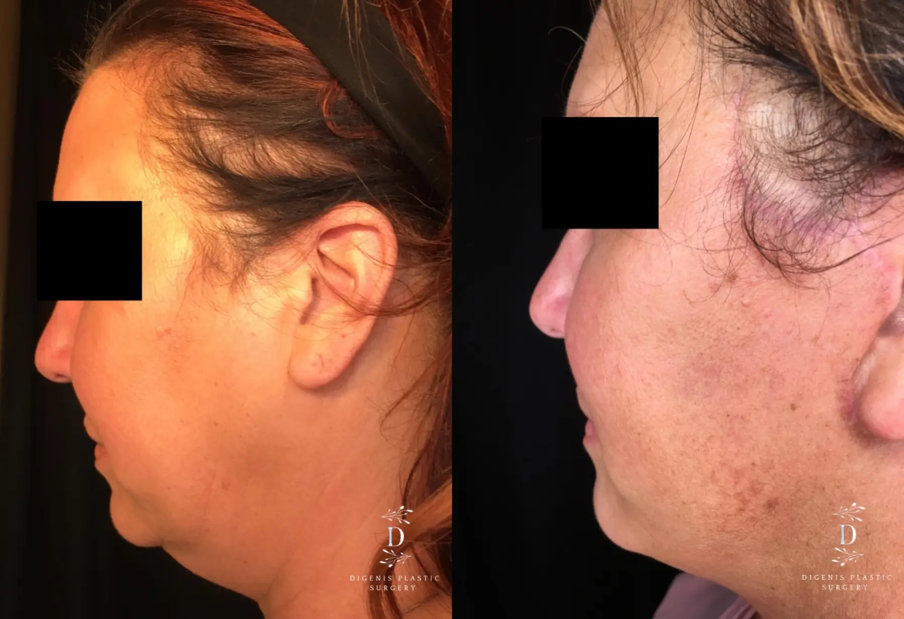 Facelift: Patient 21 - Before and After 5