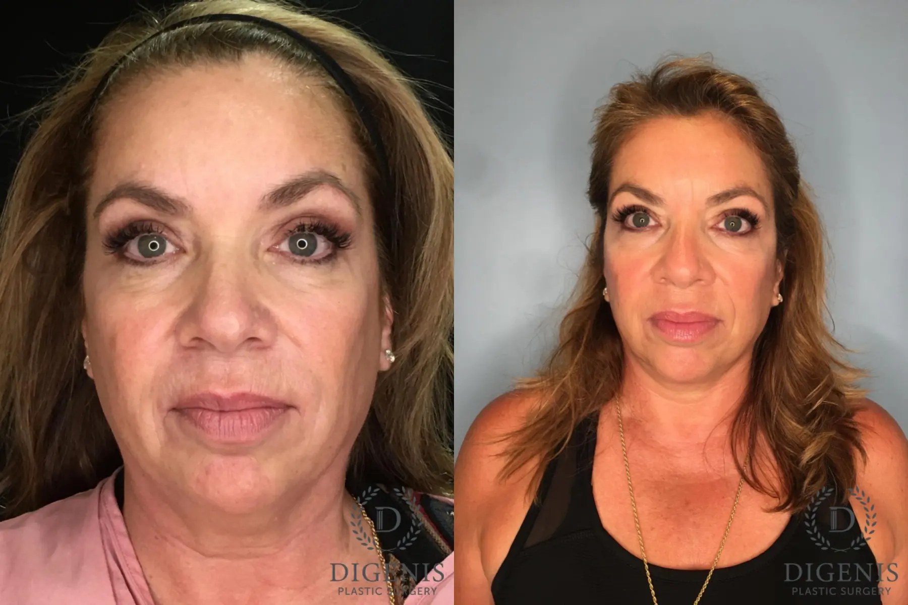 Facelift: Patient 34 - Before and After  