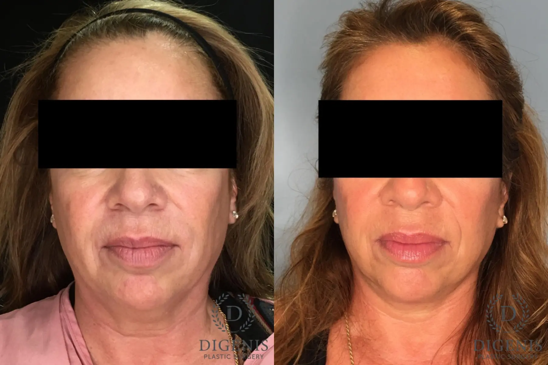 Facelift: Patient 34 - Before and After  