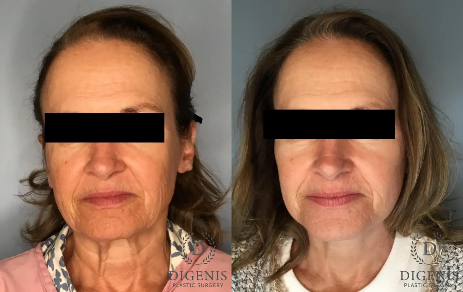 Facelift: Patient 16 - Before and After  