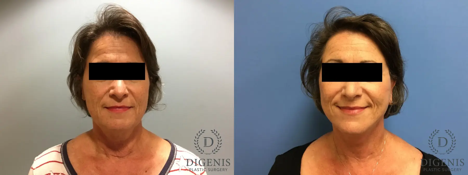 Facelift: Patient 16 - Before and After  