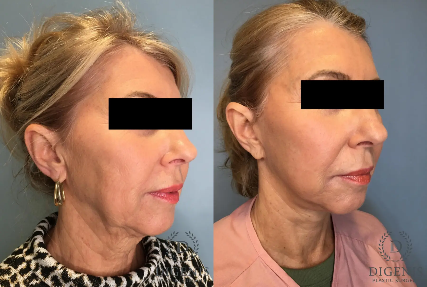 Facelift: Patient 15 - Before and After 2