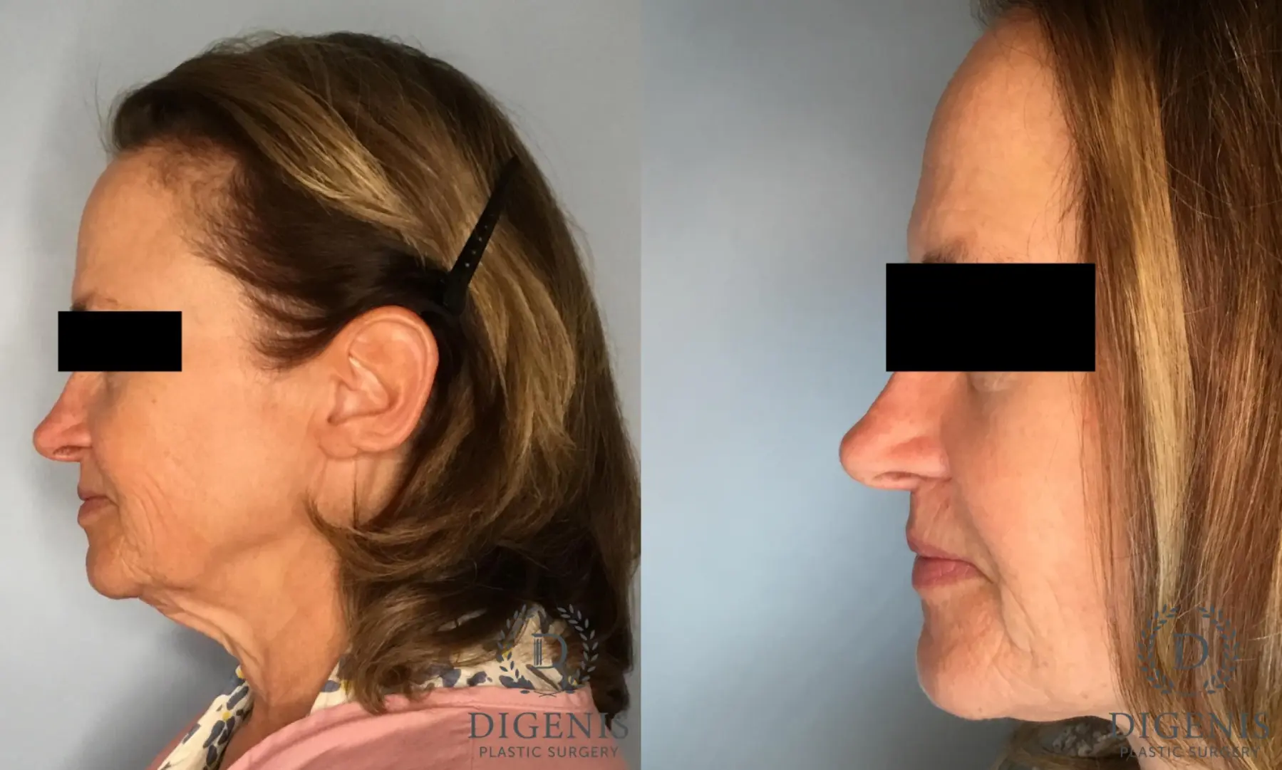 Facelift: Patient 16 - Before and After 5