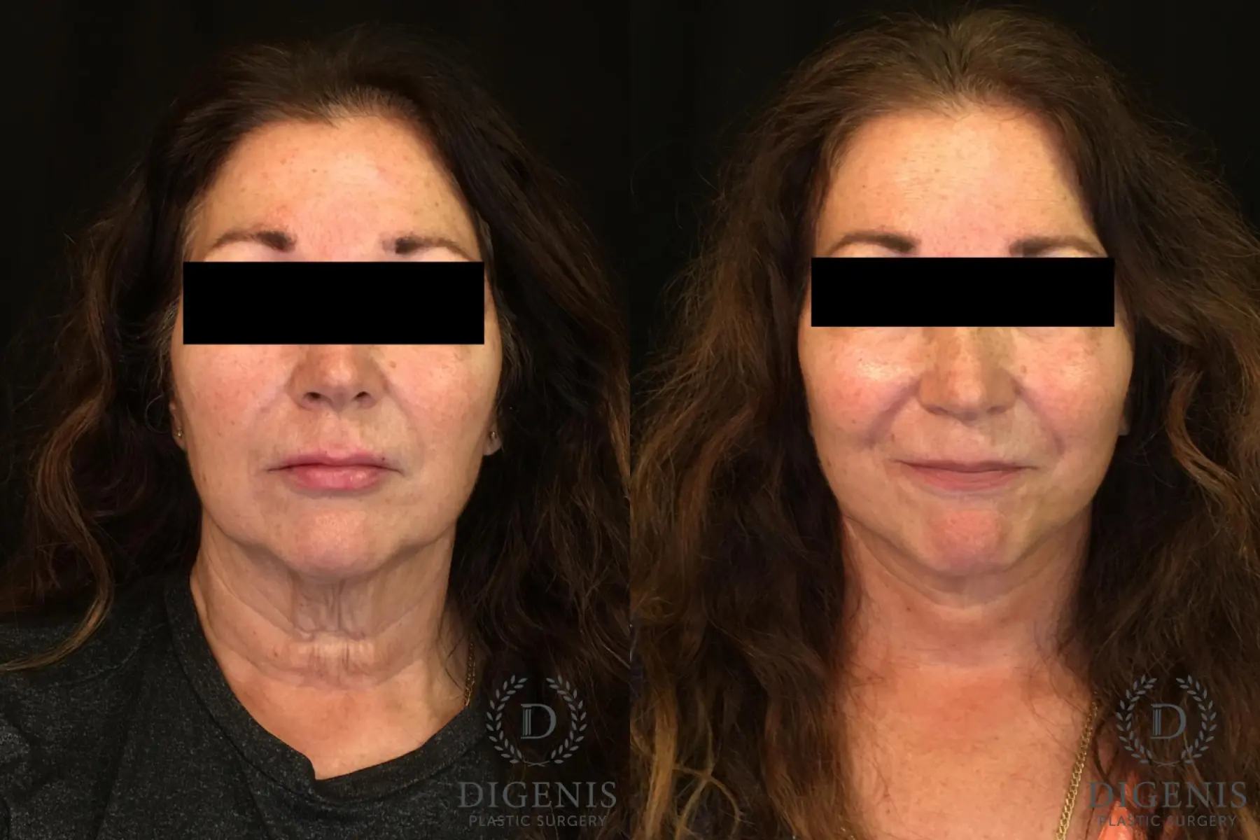 Facelift: Patient 5 - Before and After  