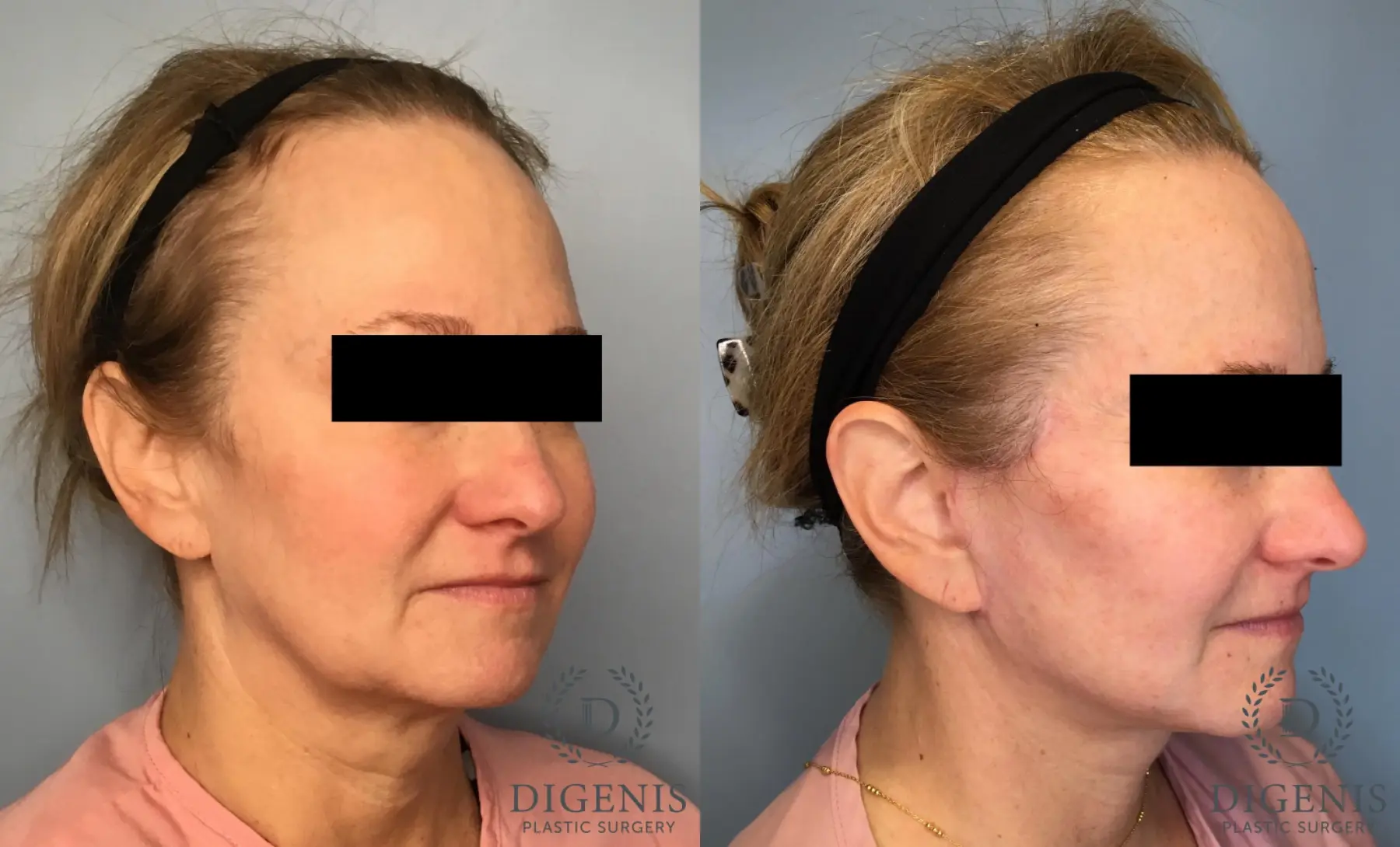 Facelift: Patient 13 - Before and After 2