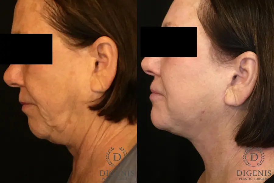 Facelift: Patient 13 - Before and After 5