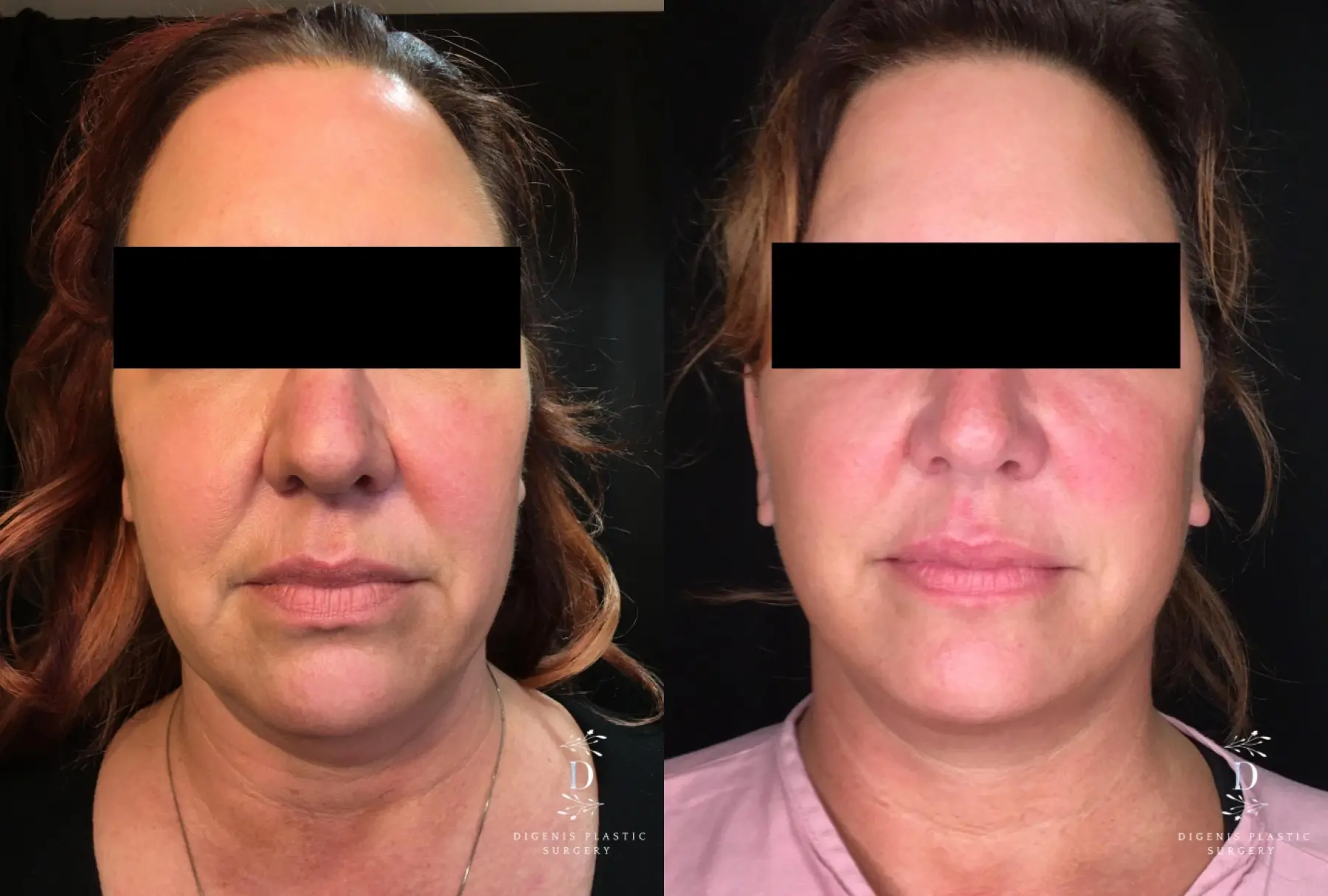 Facelift: Patient 21 - Before and After 1