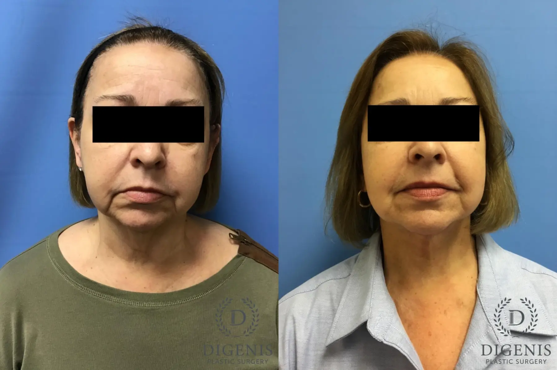 Facelift: Patient 10 - Before and After  