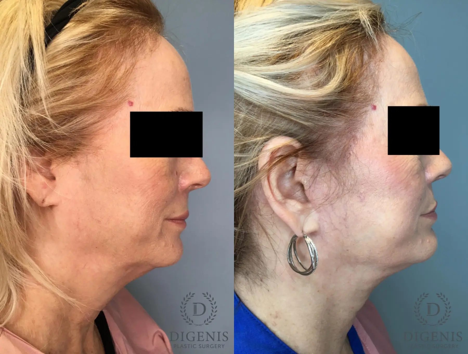 Facelift: Patient 66 - Before and After 5