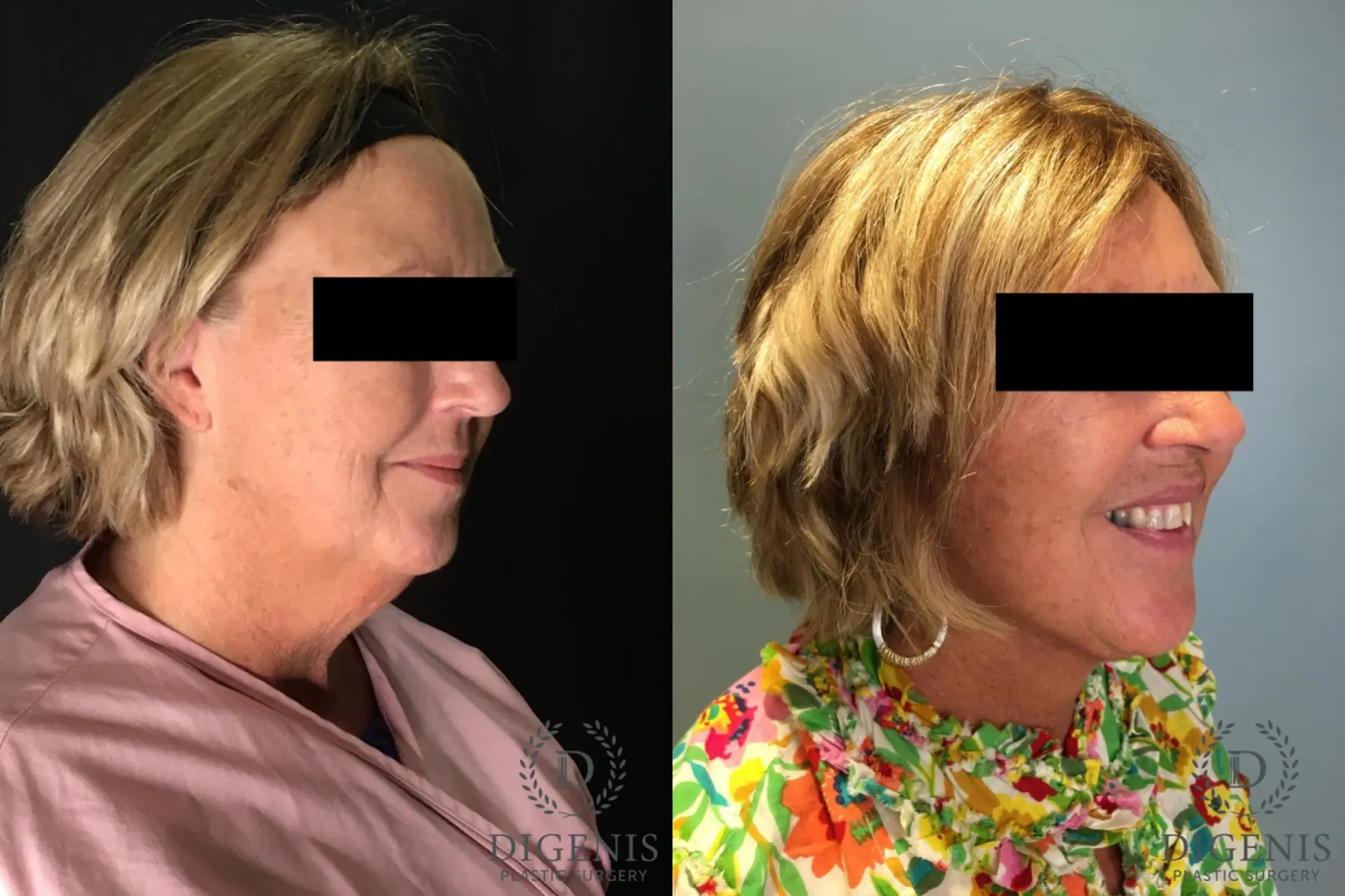 Facelift: Patient 27 - Before and After 2