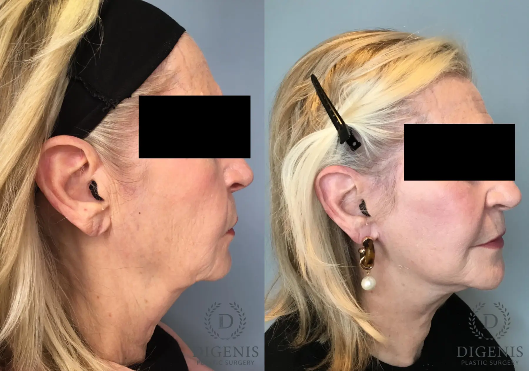 Facelift: Patient 67 - Before and After 5