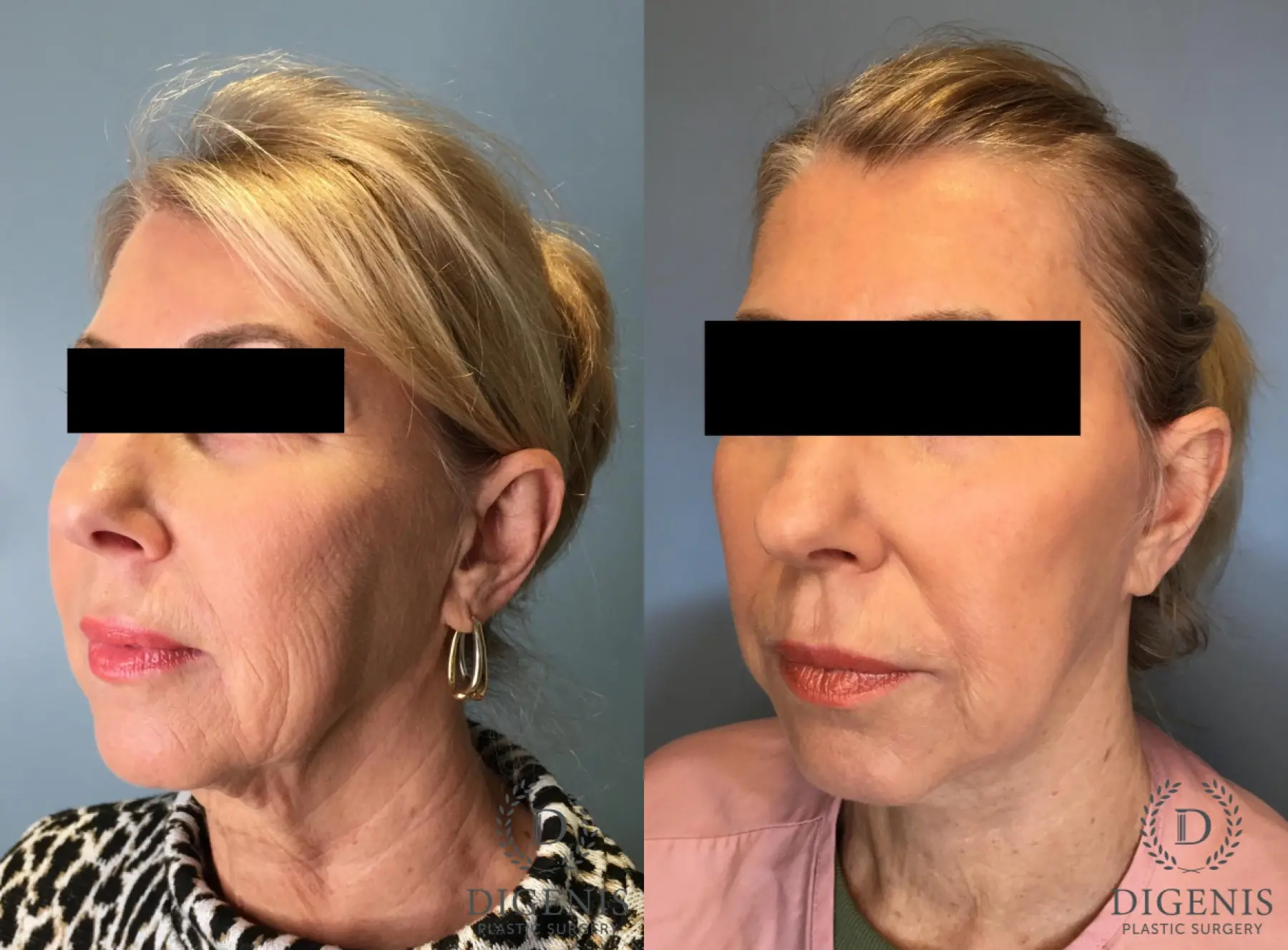 Facelift: Patient 15 - Before and After 4