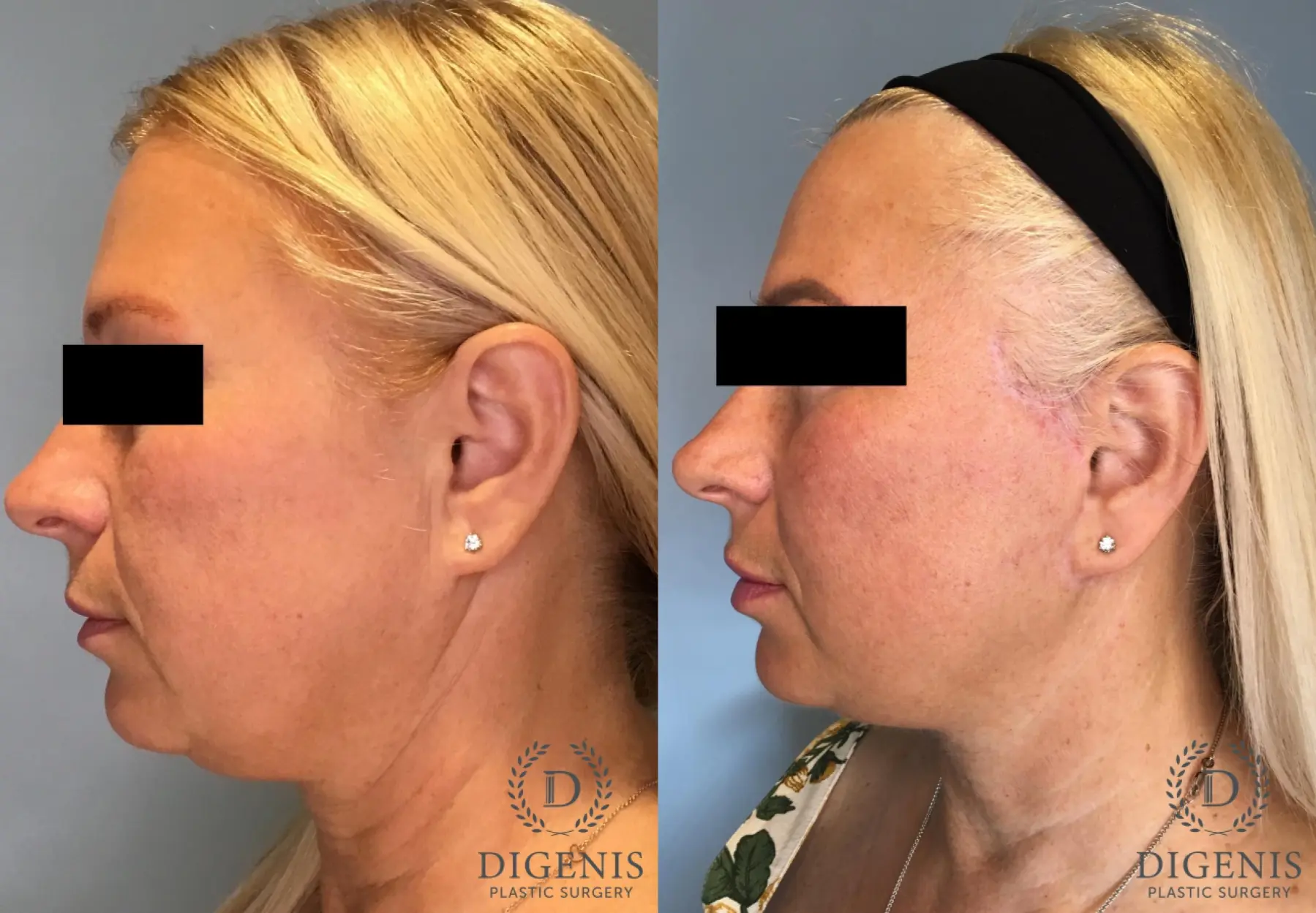 Facelift: Patient 65 - Before and After 5