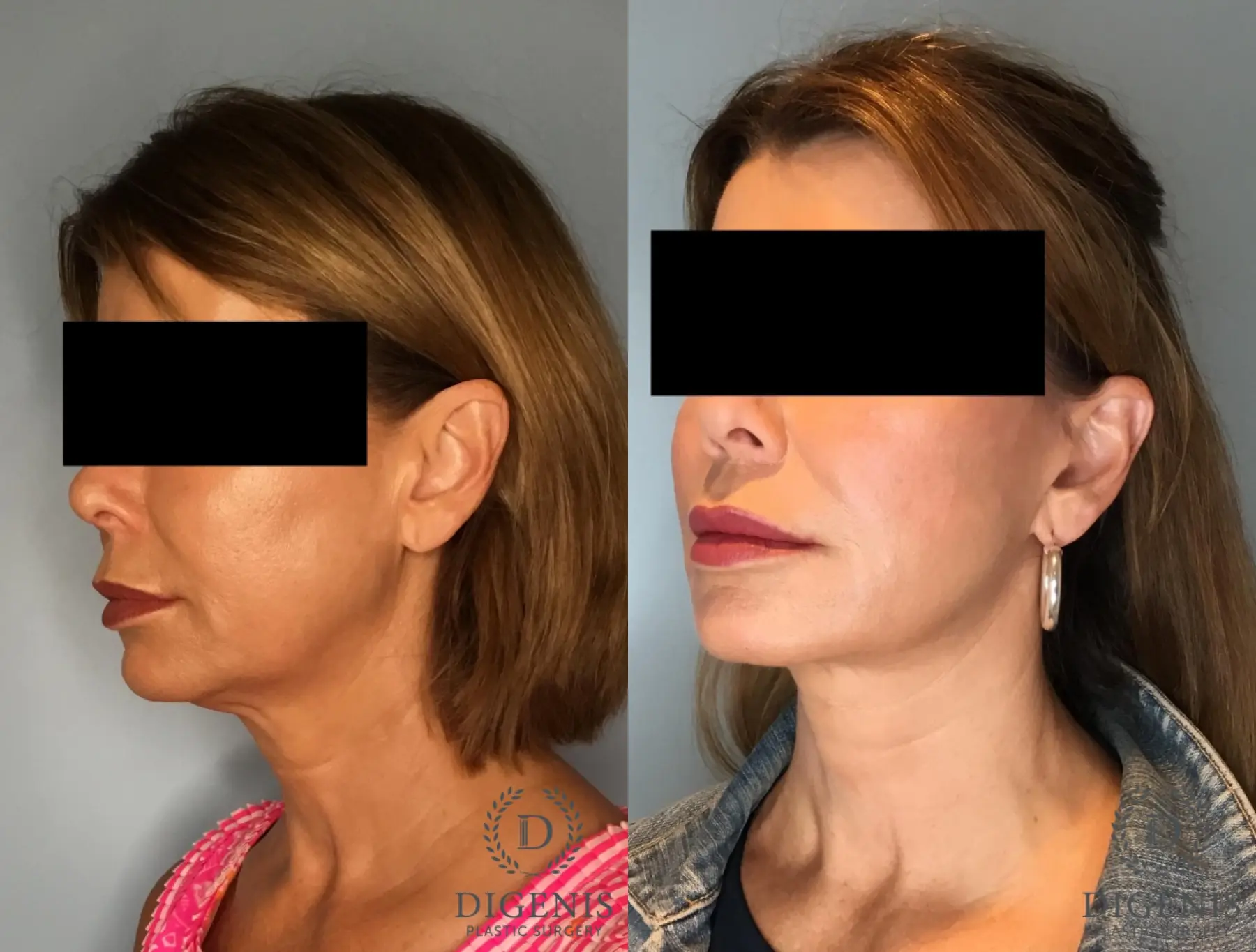 Facelift: Patient 72 - Before and After 4