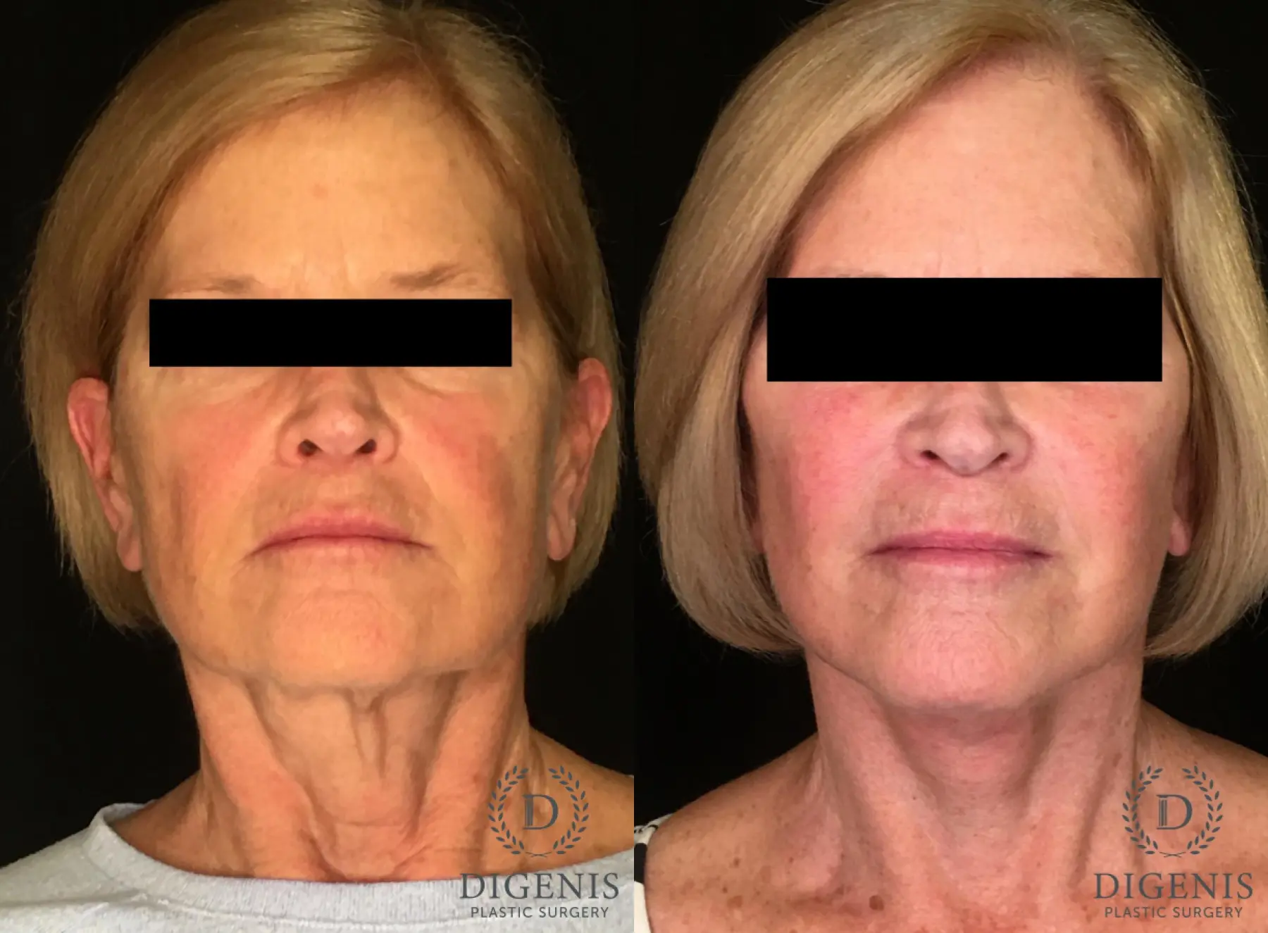 Facelift: Patient 4 - Before and After  