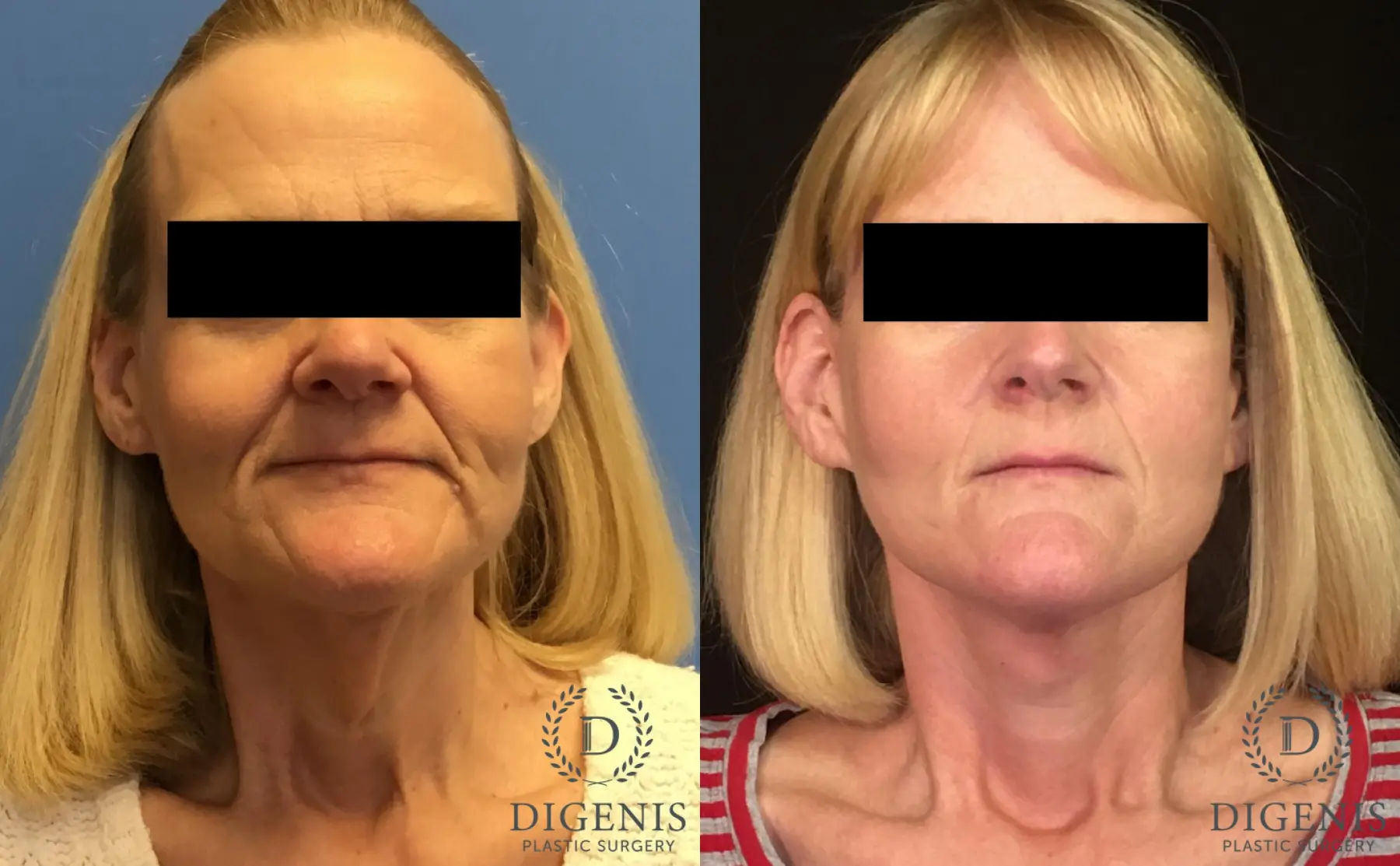 Facelift: Patient 4 - Before and After 1