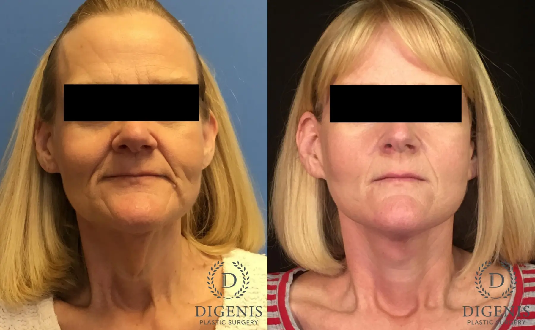 Facelift: Patient 7 - Before and After  
