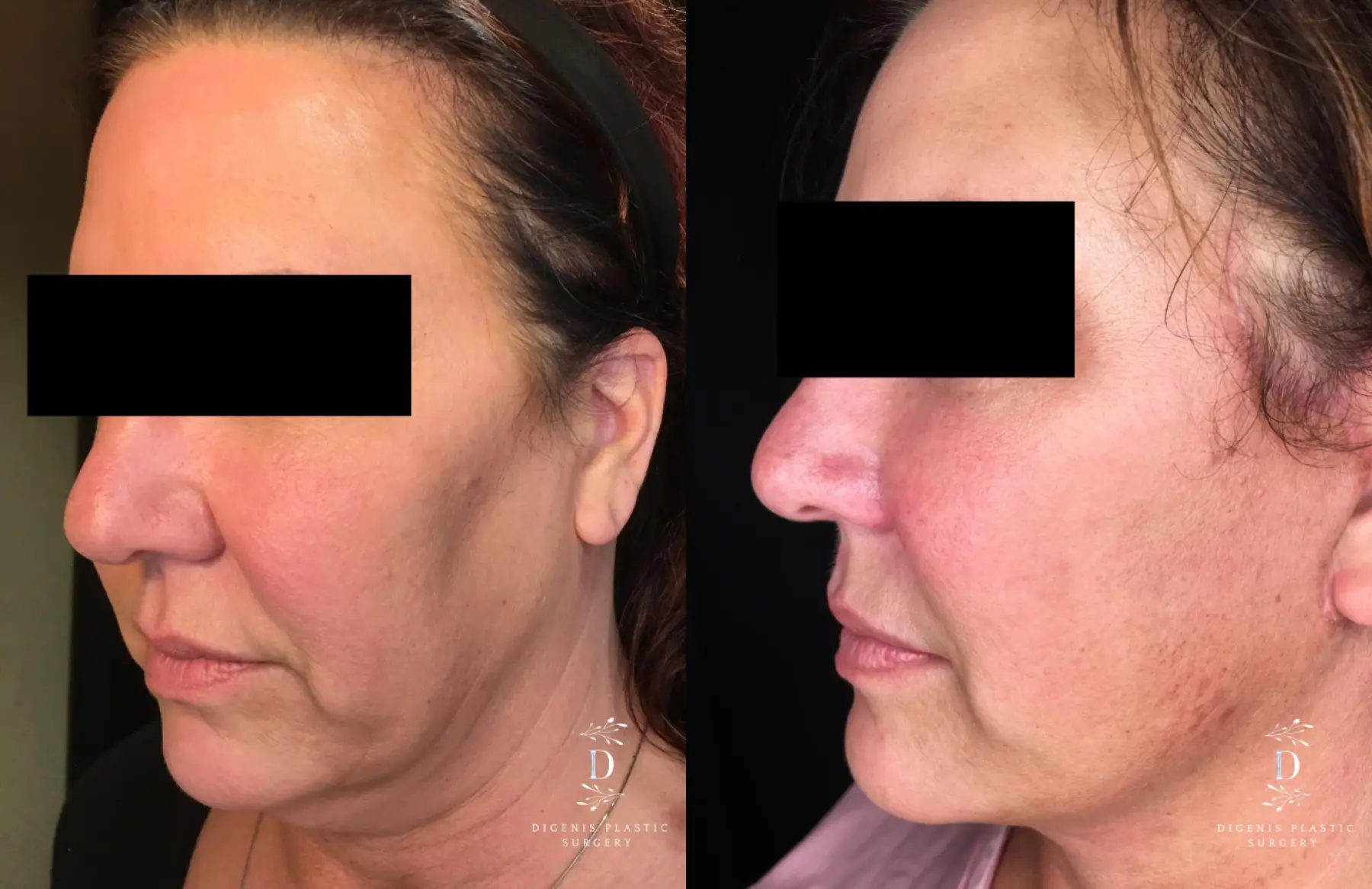 Facelift: Patient 22 - Before and After 4