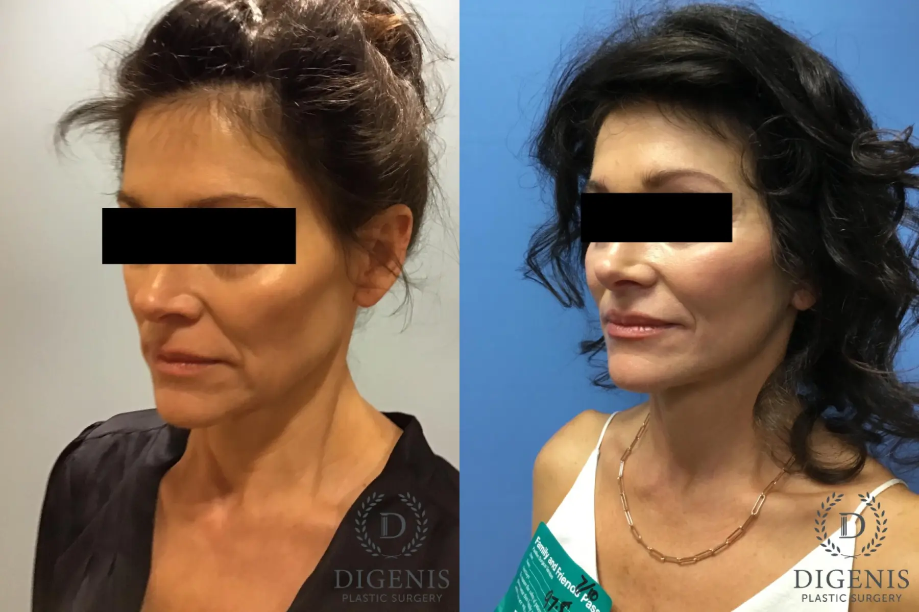 Facelift: Patient 9 - Before and After 2