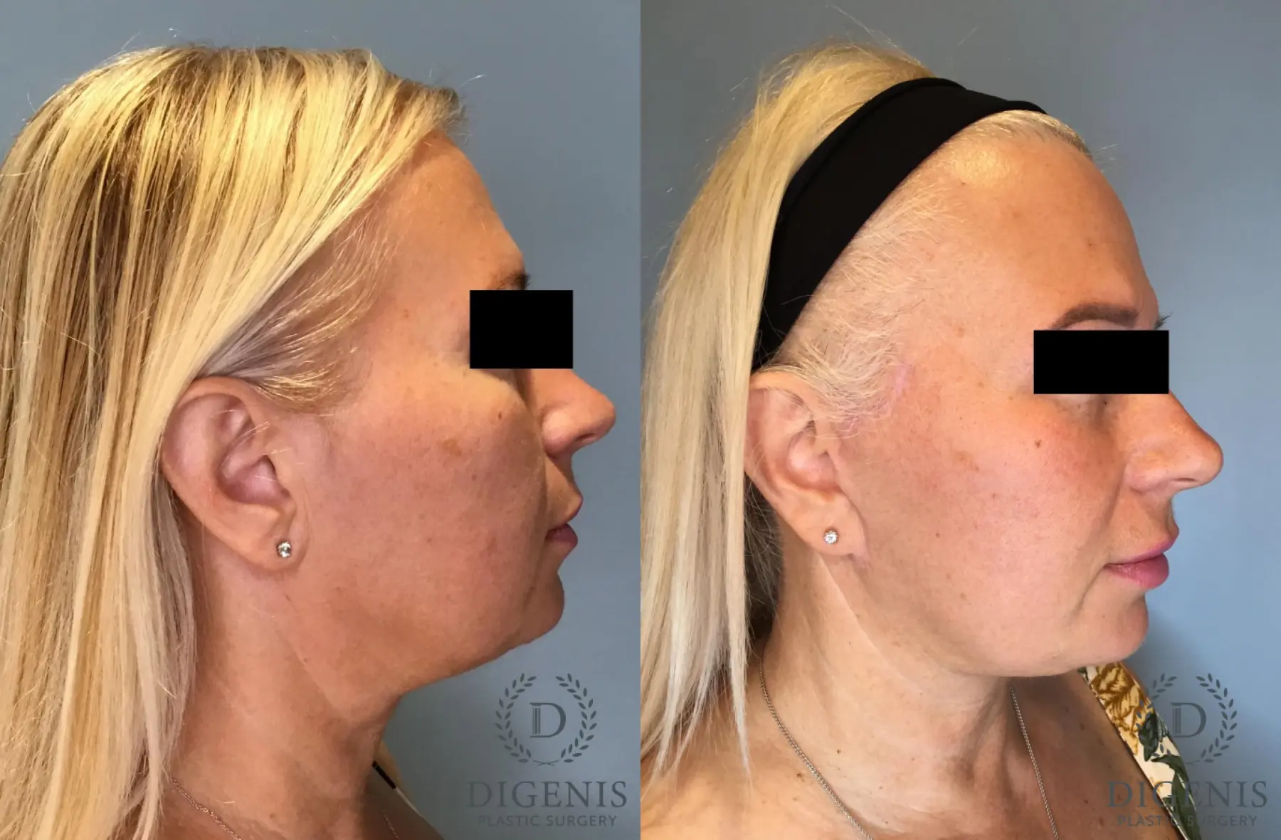 Facelift: Patient 65 - Before and After 3