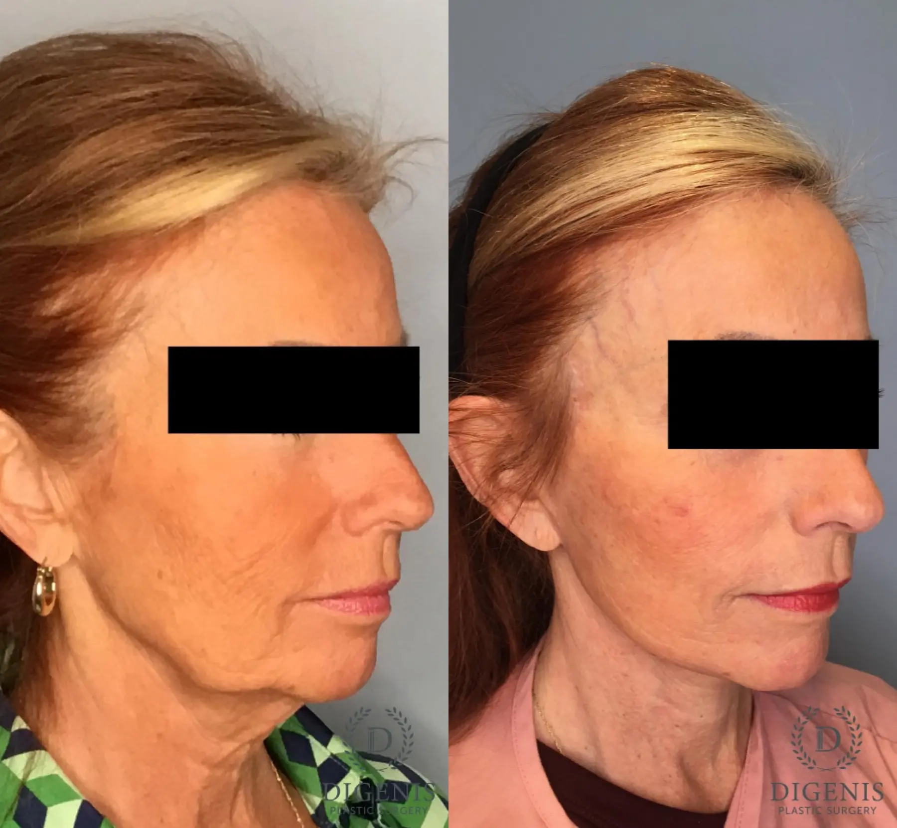Facelift: Patient 25 - Before and After 5