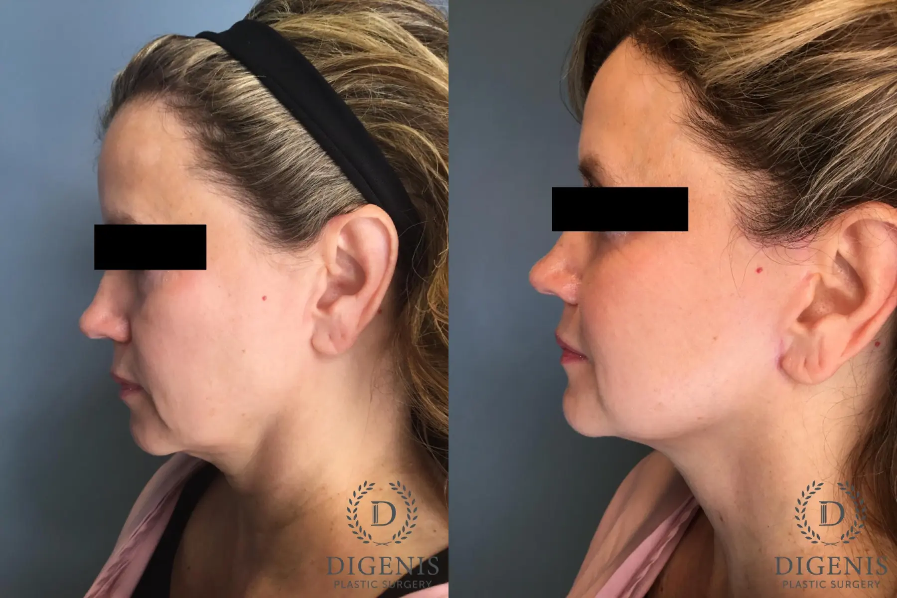Facelift: Patient 60 - Before and After 3