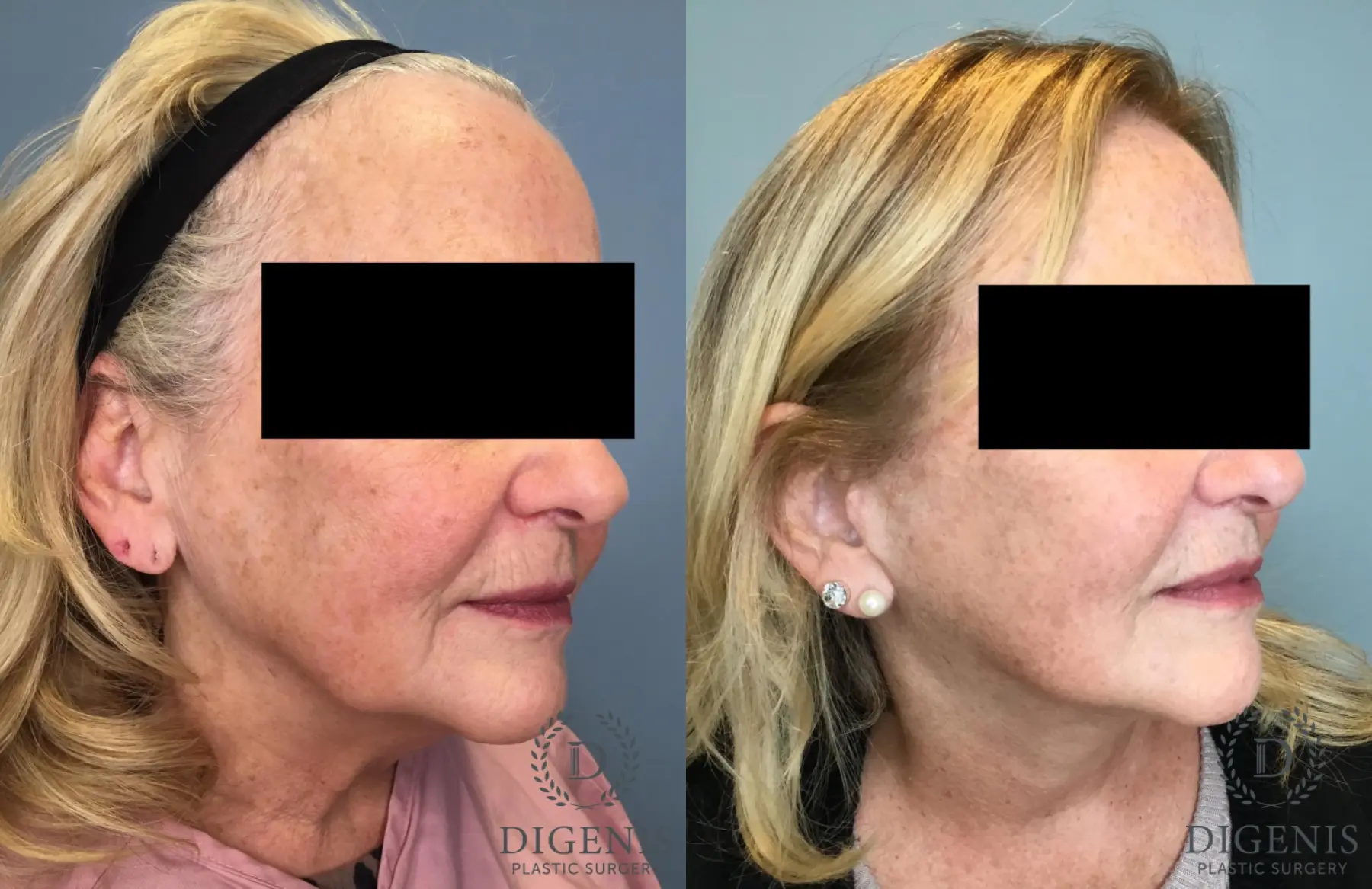 Facelift: Patient 73 - Before and After 4