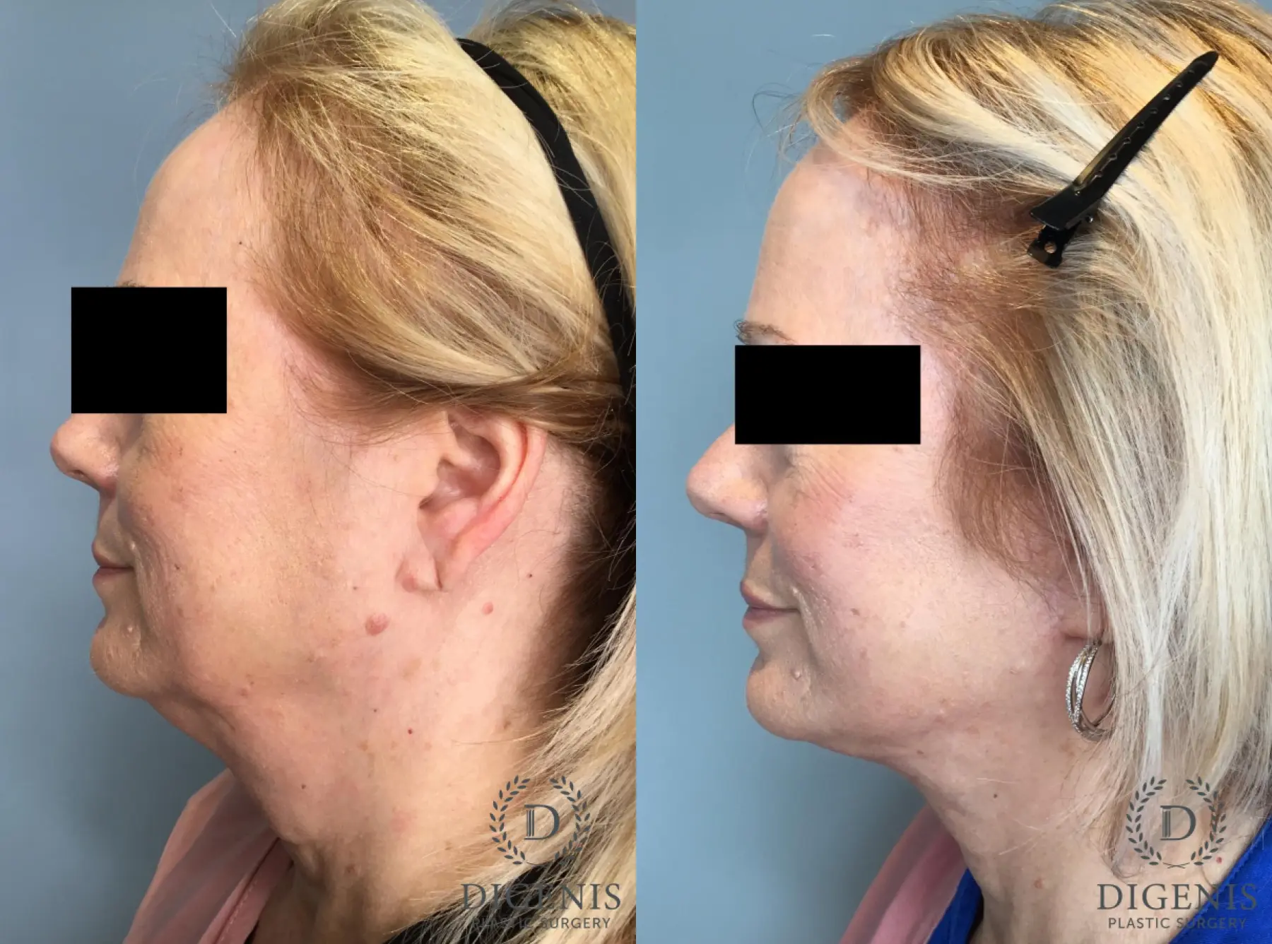 Facelift: Patient 66 - Before and After 3