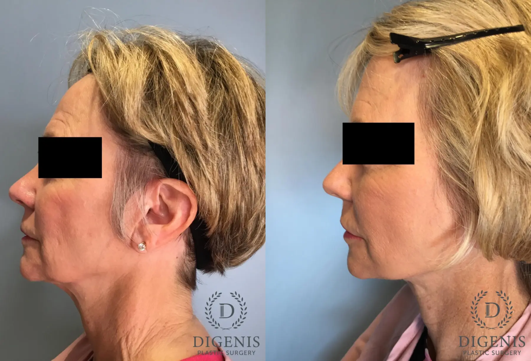 Facelift: Patient 14 - Before and After 3