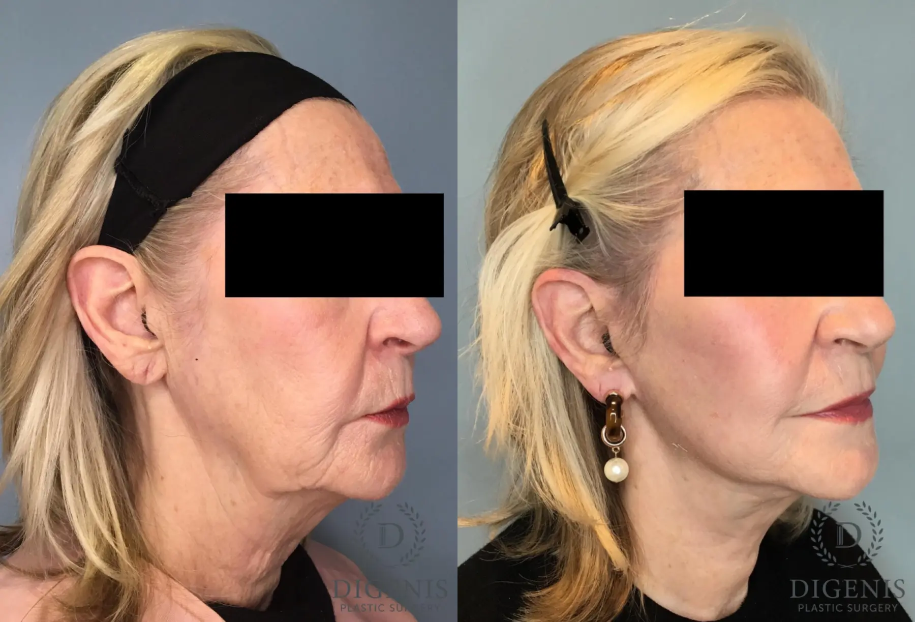Facelift: Patient 67 - Before and After 4