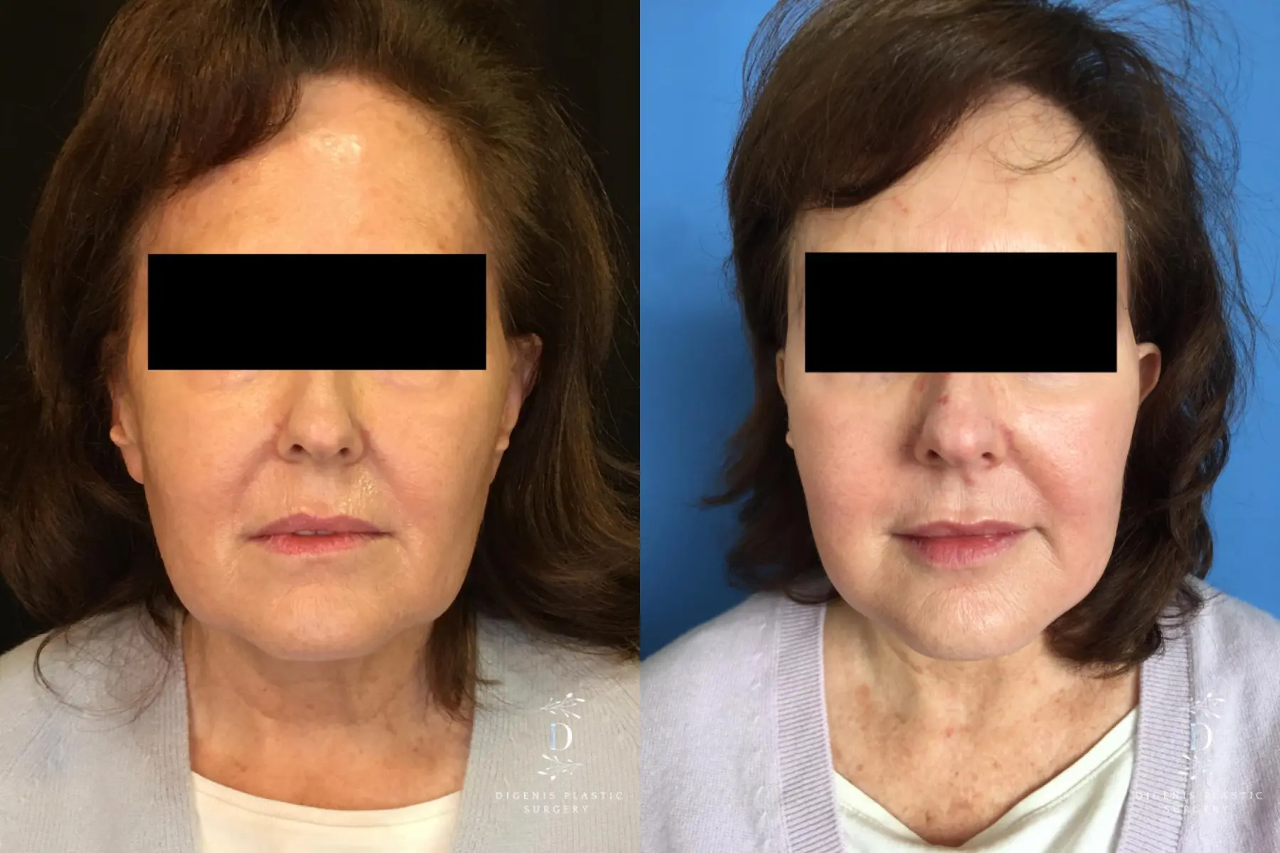 Facelift: Patient 18 - Before and After  